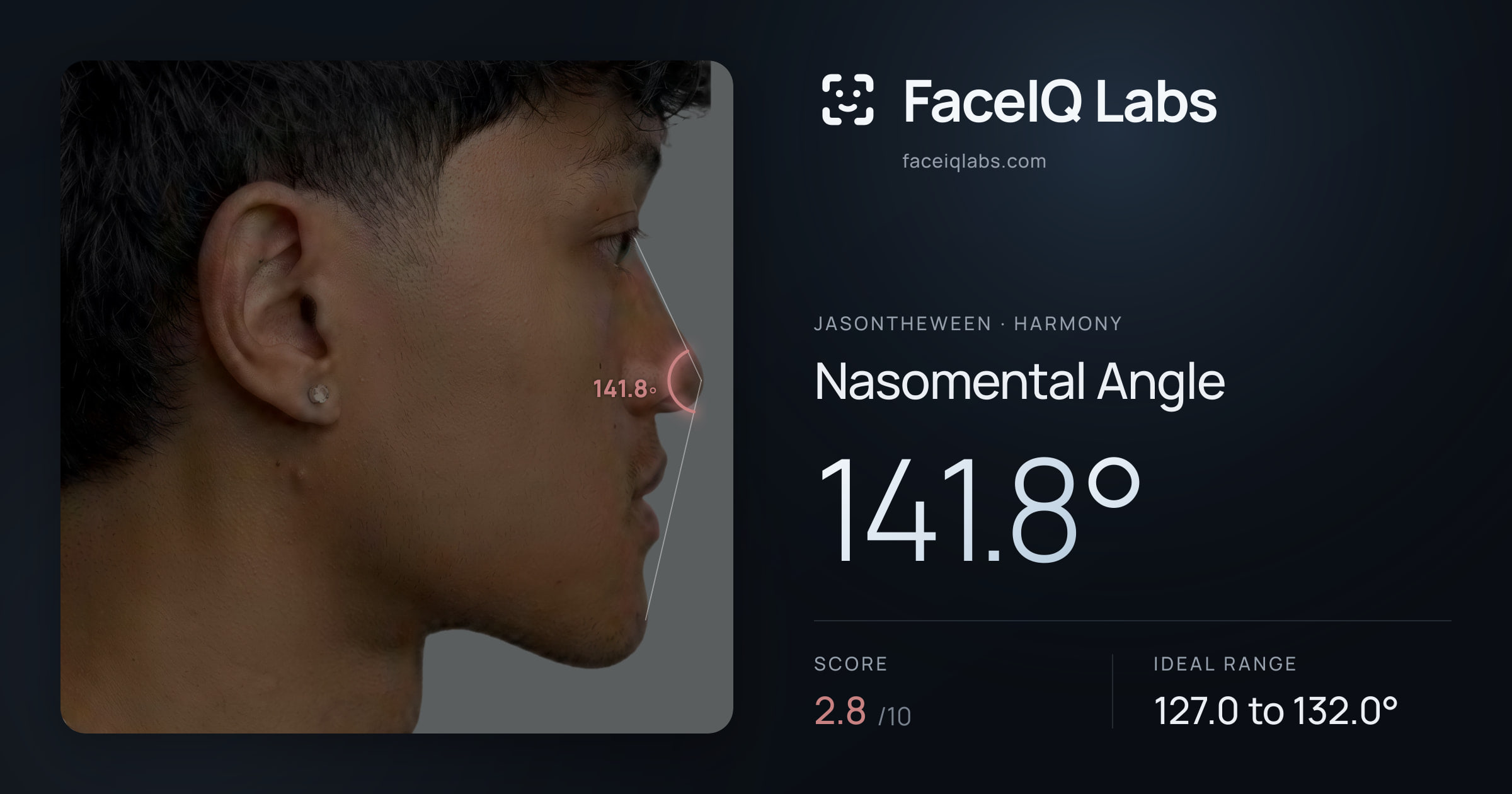 Jasontheween Nasomental Angle: 141.8°, drawn on the photo