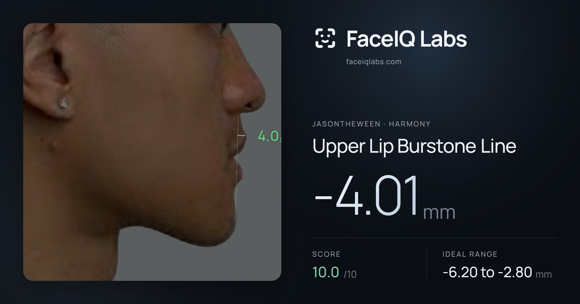 Jasontheween Upper Lip Burstone Line: -4.01mm, drawn on the photo