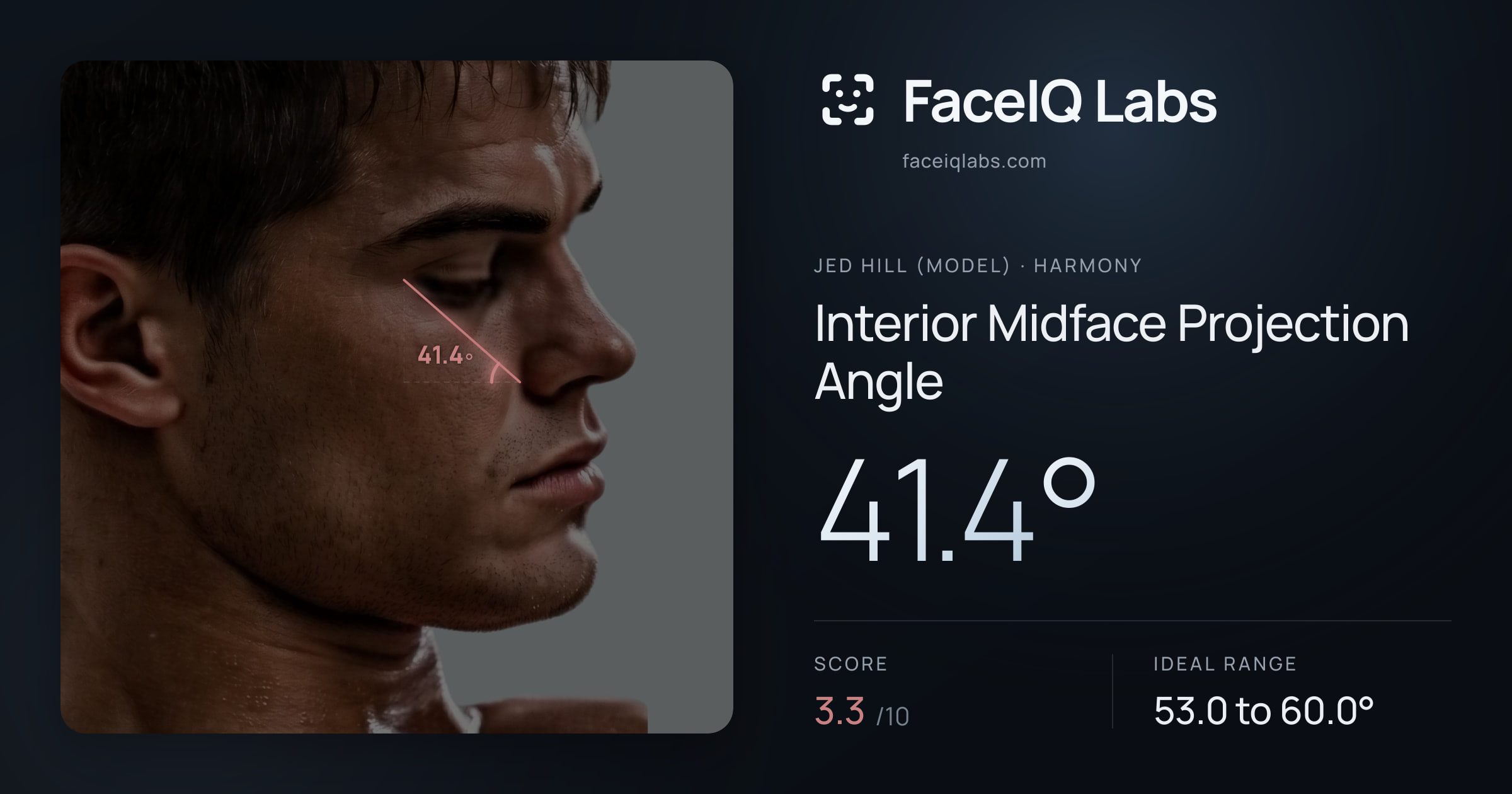 Jed Hill (Model) Interior Midface Projection Angle: 41.4°, drawn on the photo