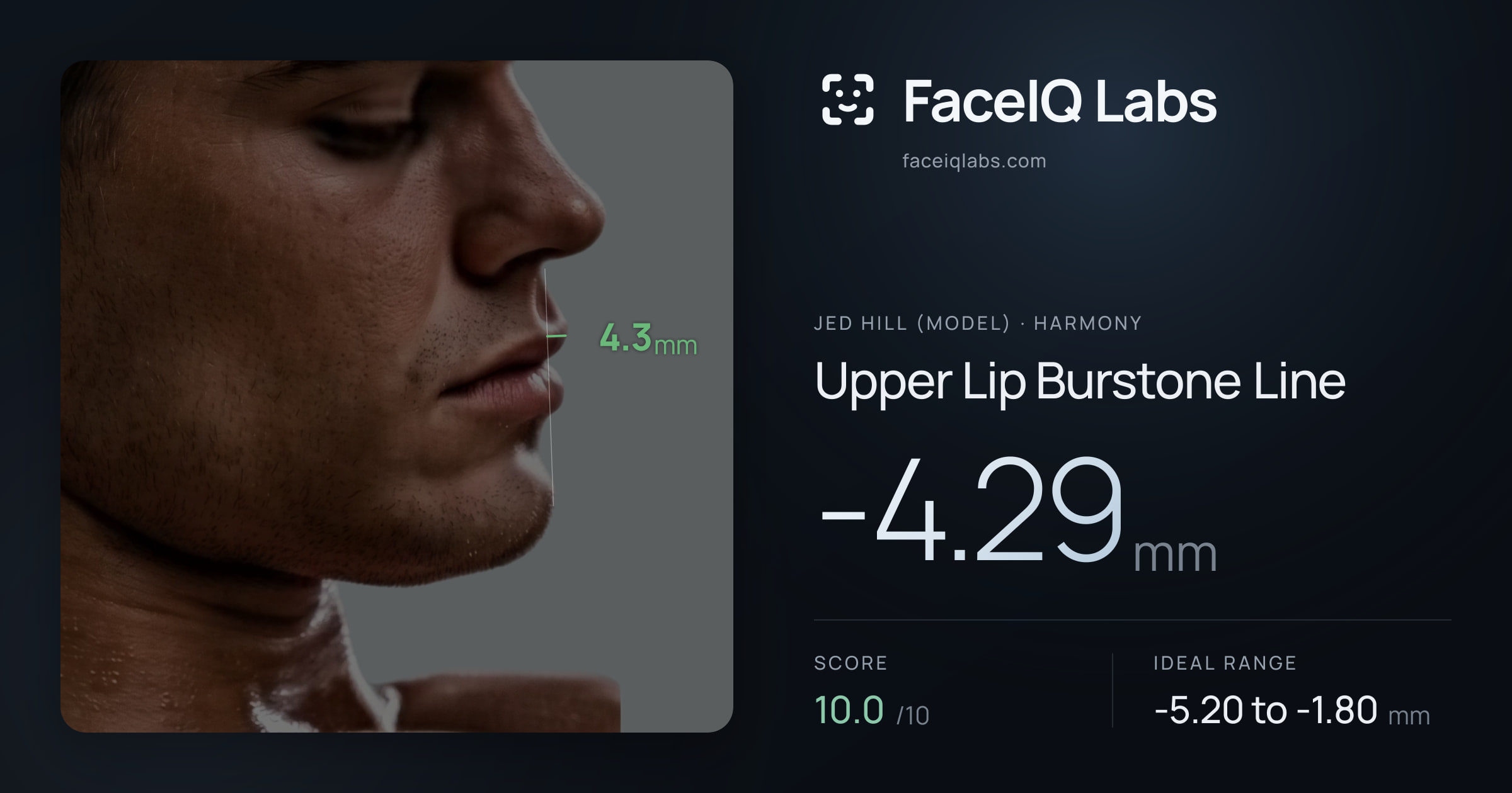 Jed Hill (Model) Upper Lip Burstone Line: -4.29mm, drawn on the photo