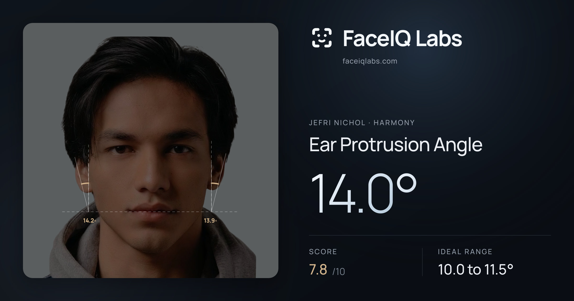 Jefri Nichol Ear Protrusion Angle: 14.0°, drawn on the photo