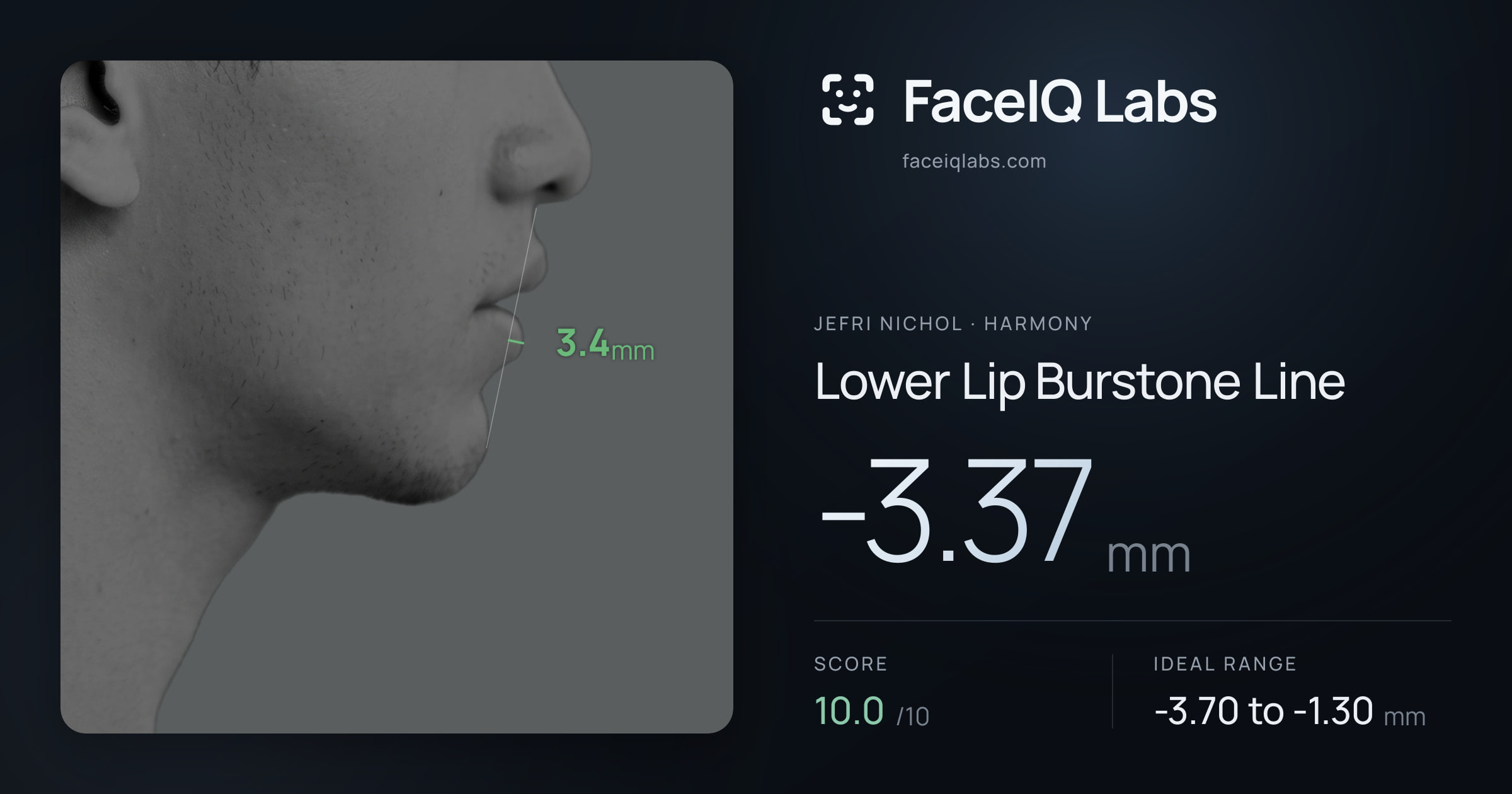 Jefri Nichol Lower Lip Burstone Line: -3.37mm, drawn on the photo