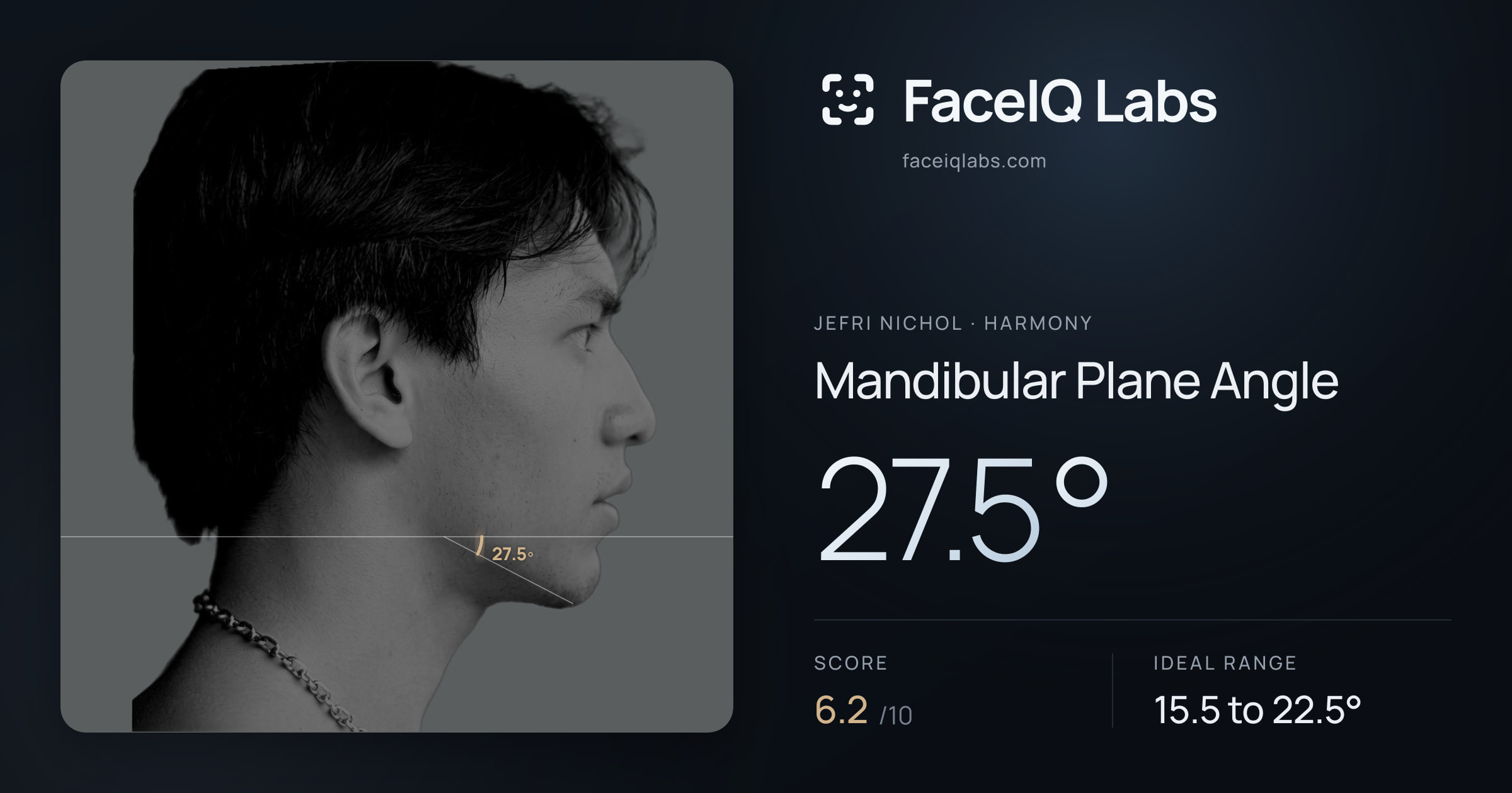 Jefri Nichol Mandibular Plane Angle: 27.5°, drawn on the photo