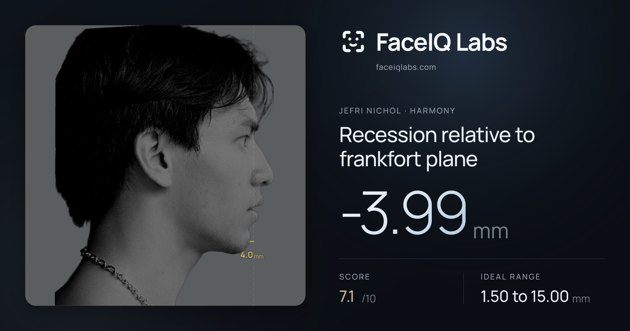 Jefri Nichol Recession relative to frankfort plane: -3.99mm, drawn on the photo