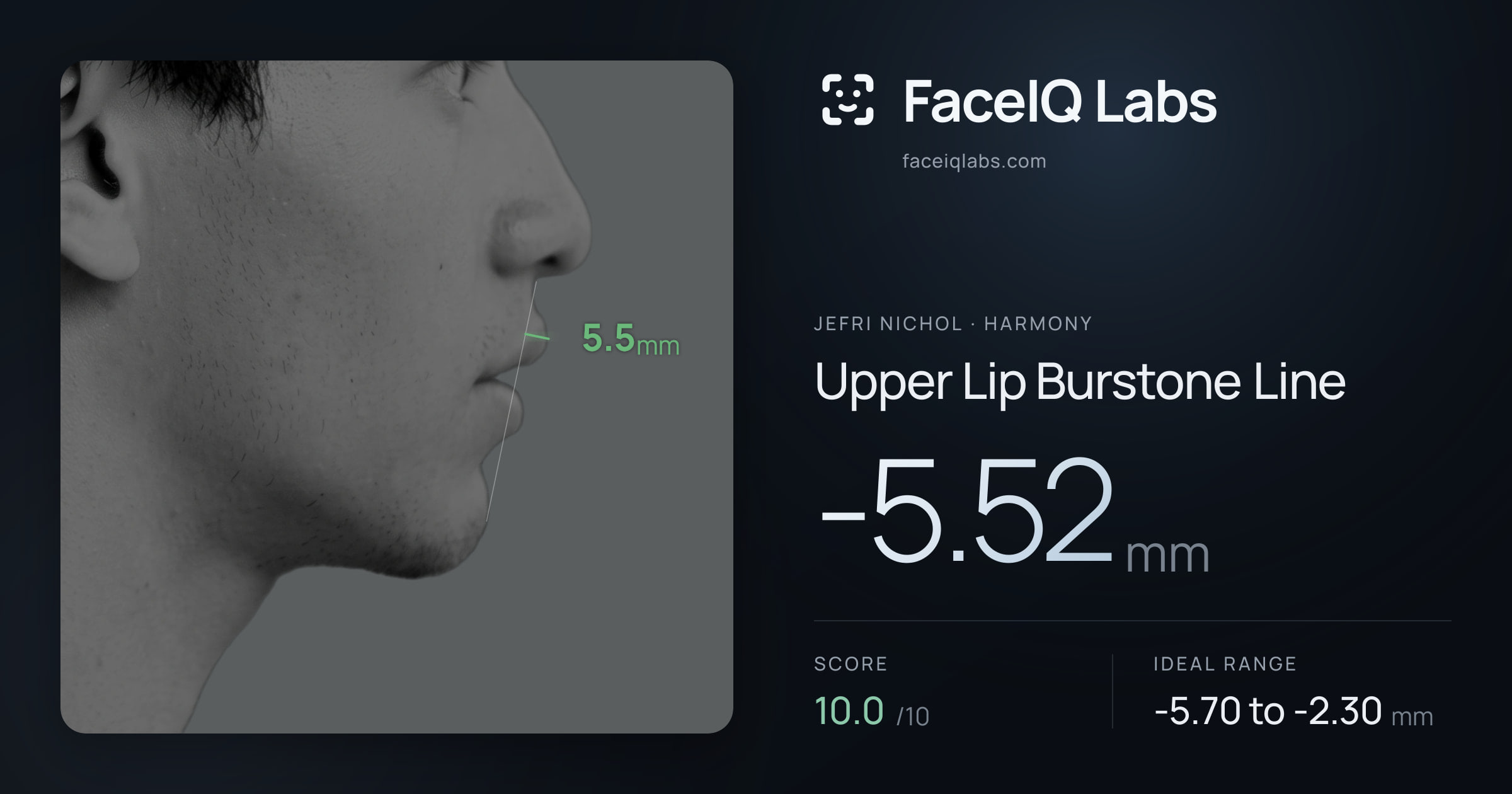 Jefri Nichol Upper Lip Burstone Line: -5.52mm, drawn on the photo