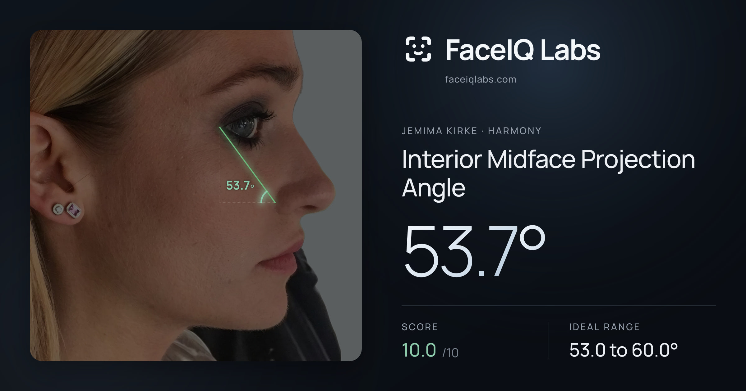 Jemima Kirke Interior Midface Projection Angle: 53.7°, drawn on the photo