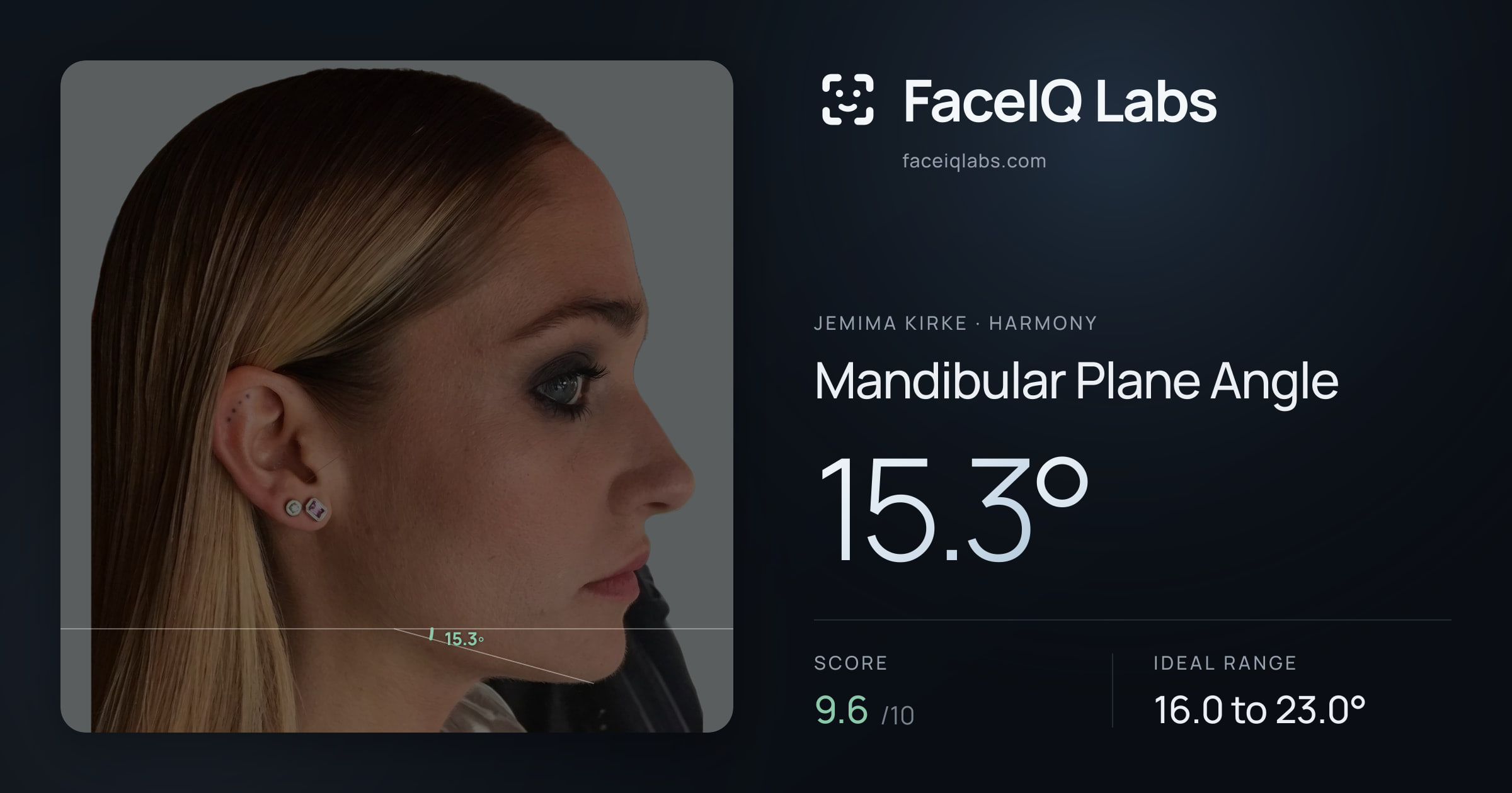 Jemima Kirke Mandibular Plane Angle: 15.3°, drawn on the photo