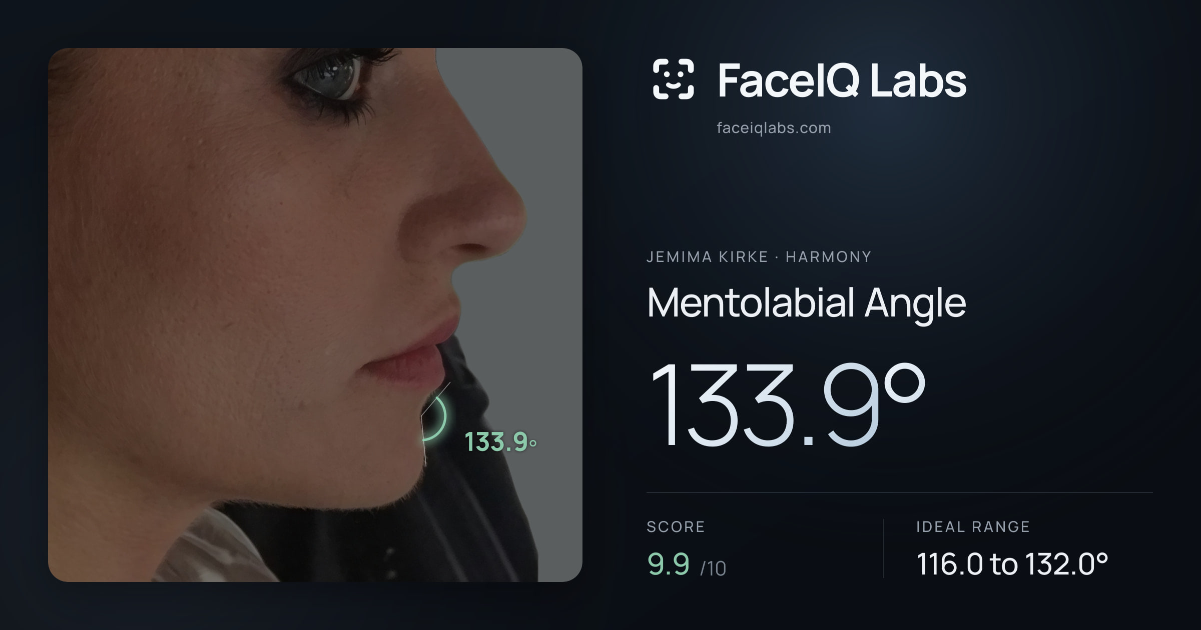 Jemima Kirke Mentolabial Angle: 133.9°, drawn on the photo