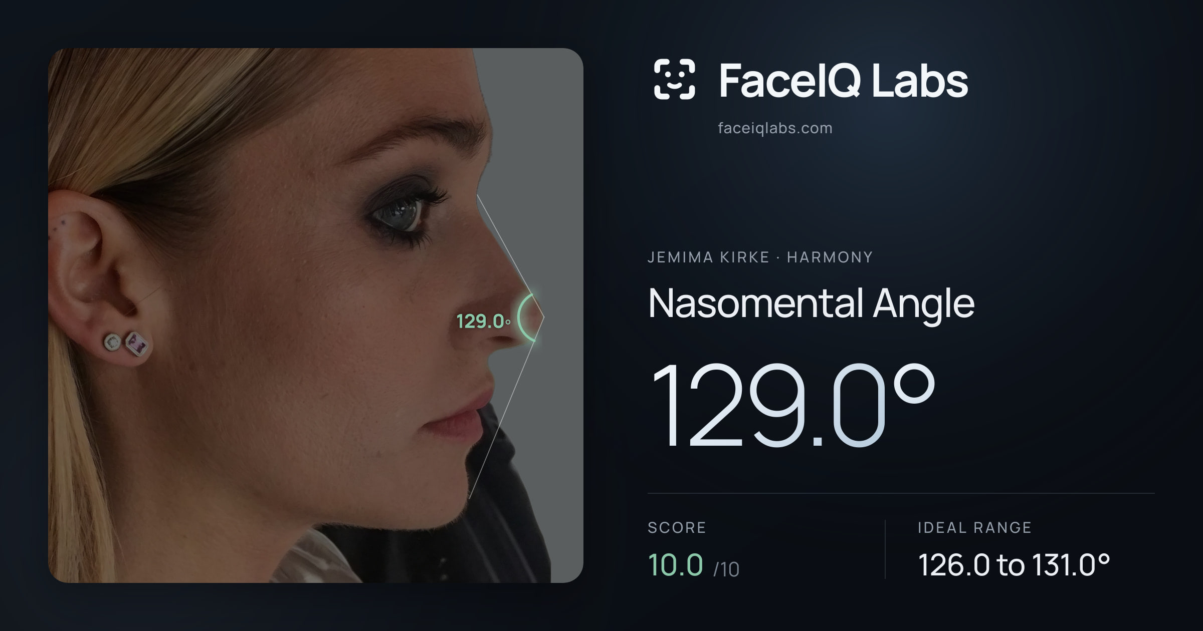 Jemima Kirke Nasomental Angle: 129.0°, drawn on the photo