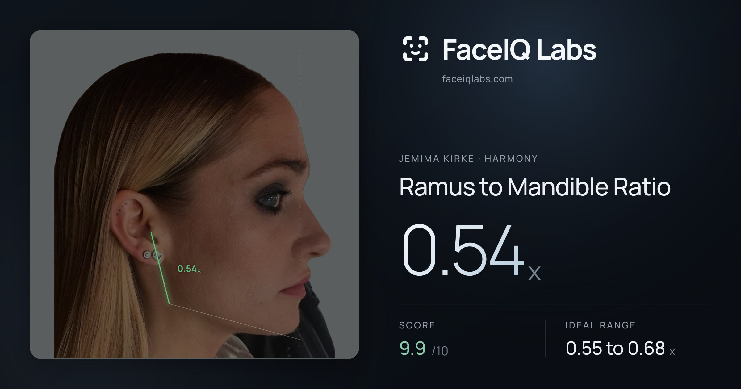 Jemima Kirke Ramus to Mandible Ratio: 0.54x, drawn on the photo