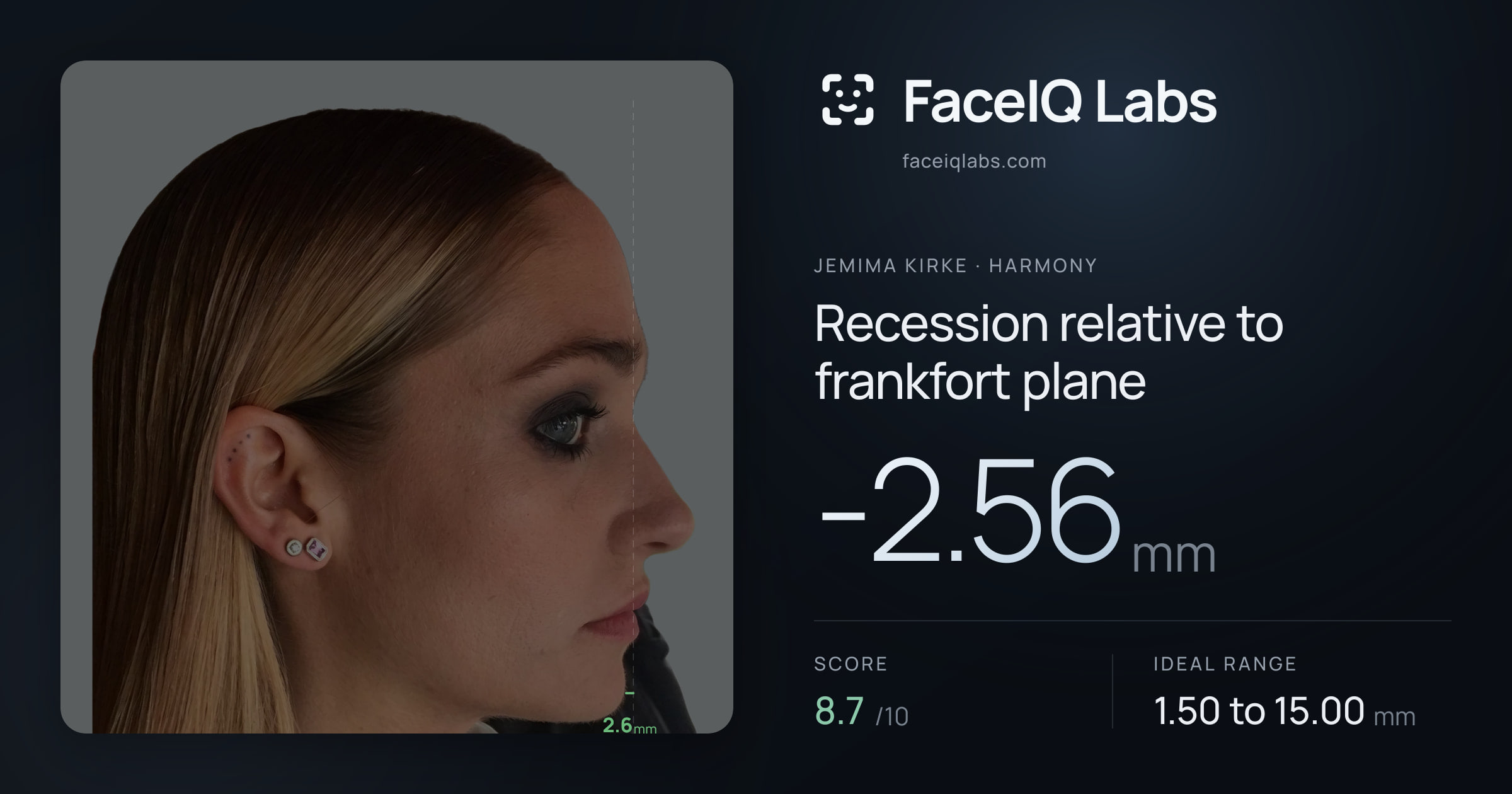 Jemima Kirke Recession relative to frankfort plane: -2.56mm, drawn on the photo