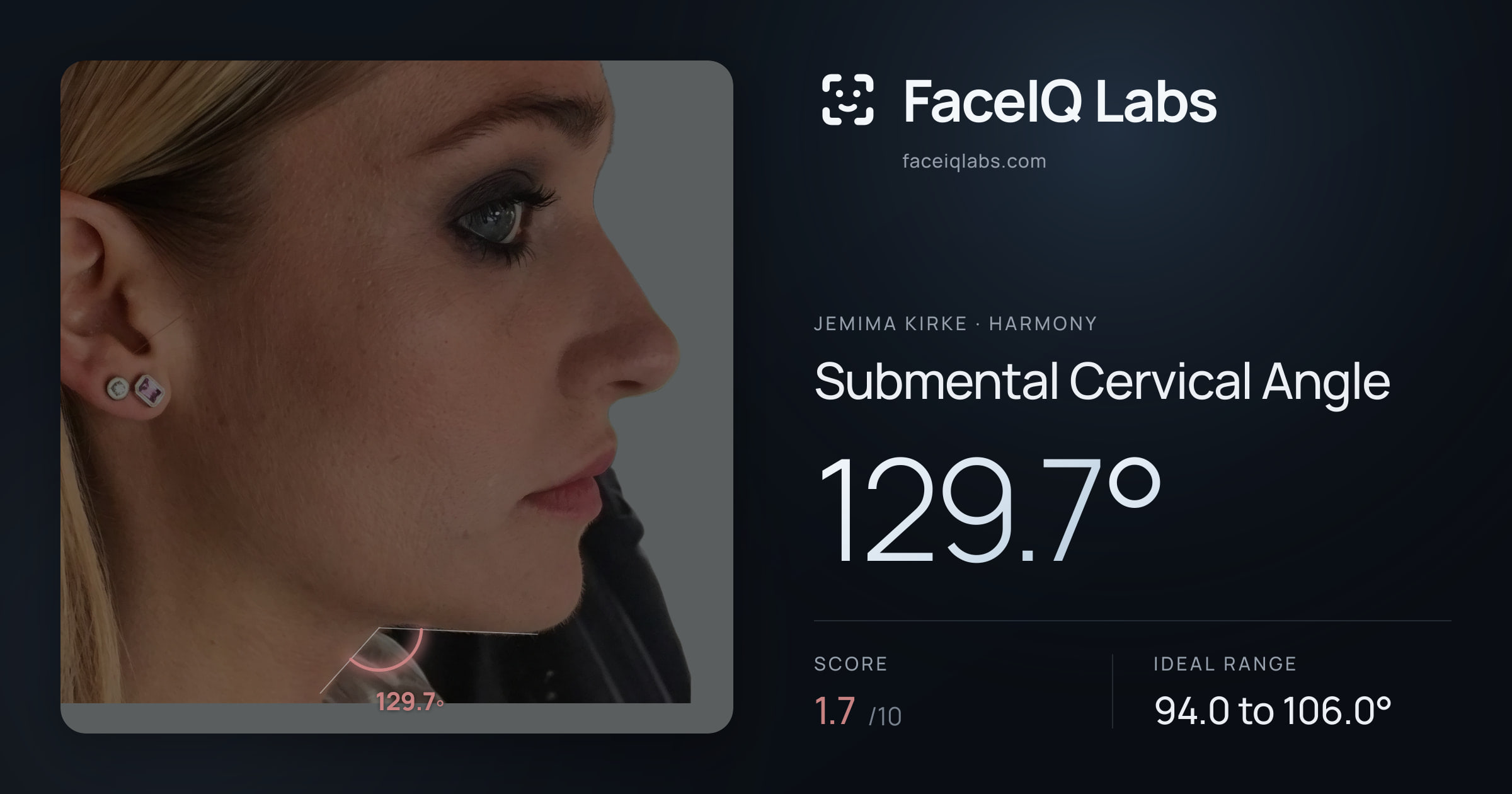 Jemima Kirke Submental Cervical Angle: 129.7°, drawn on the photo