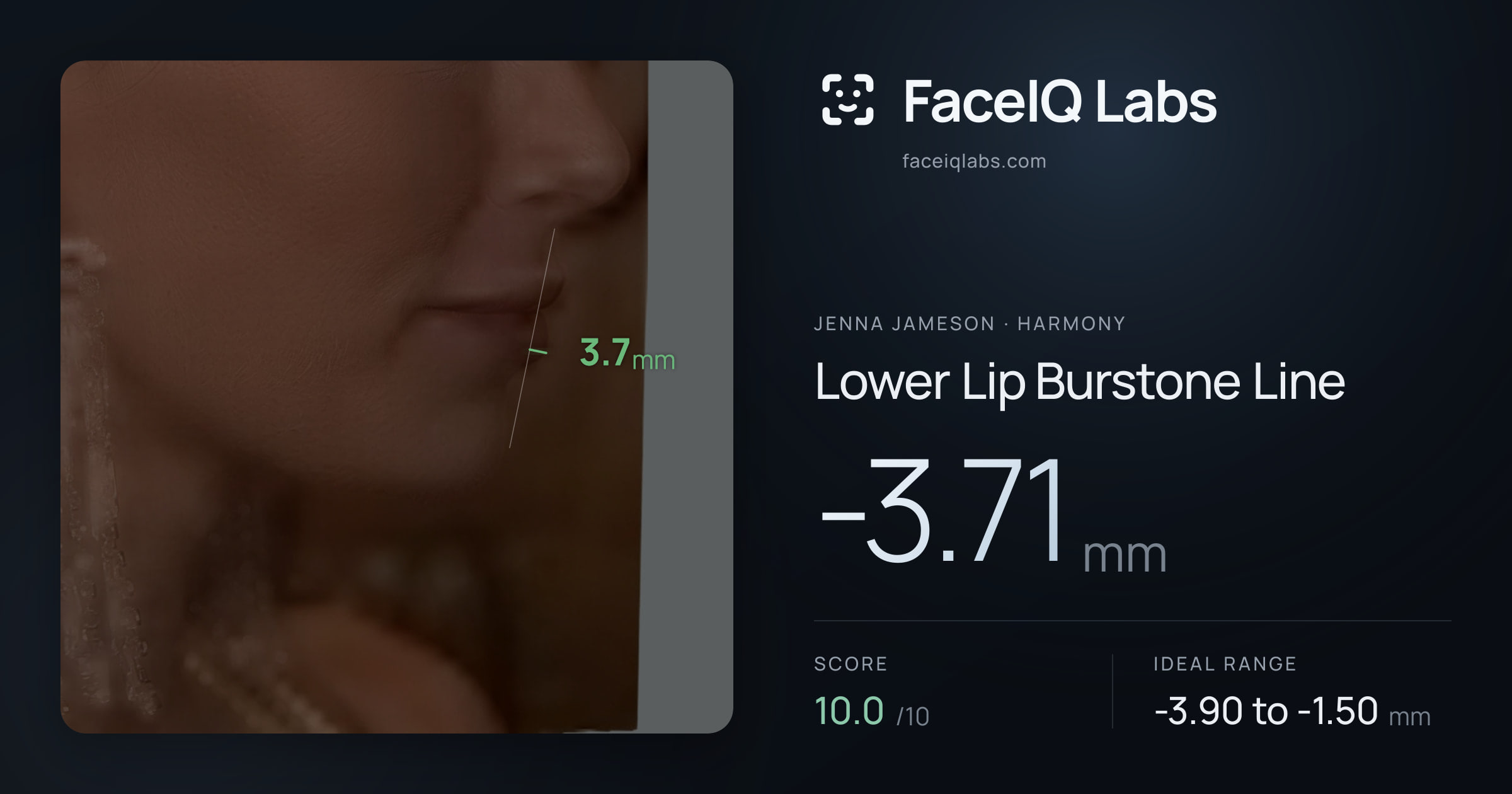 Jenna Jameson Lower Lip Burstone Line: -3.71mm, drawn on the photo
