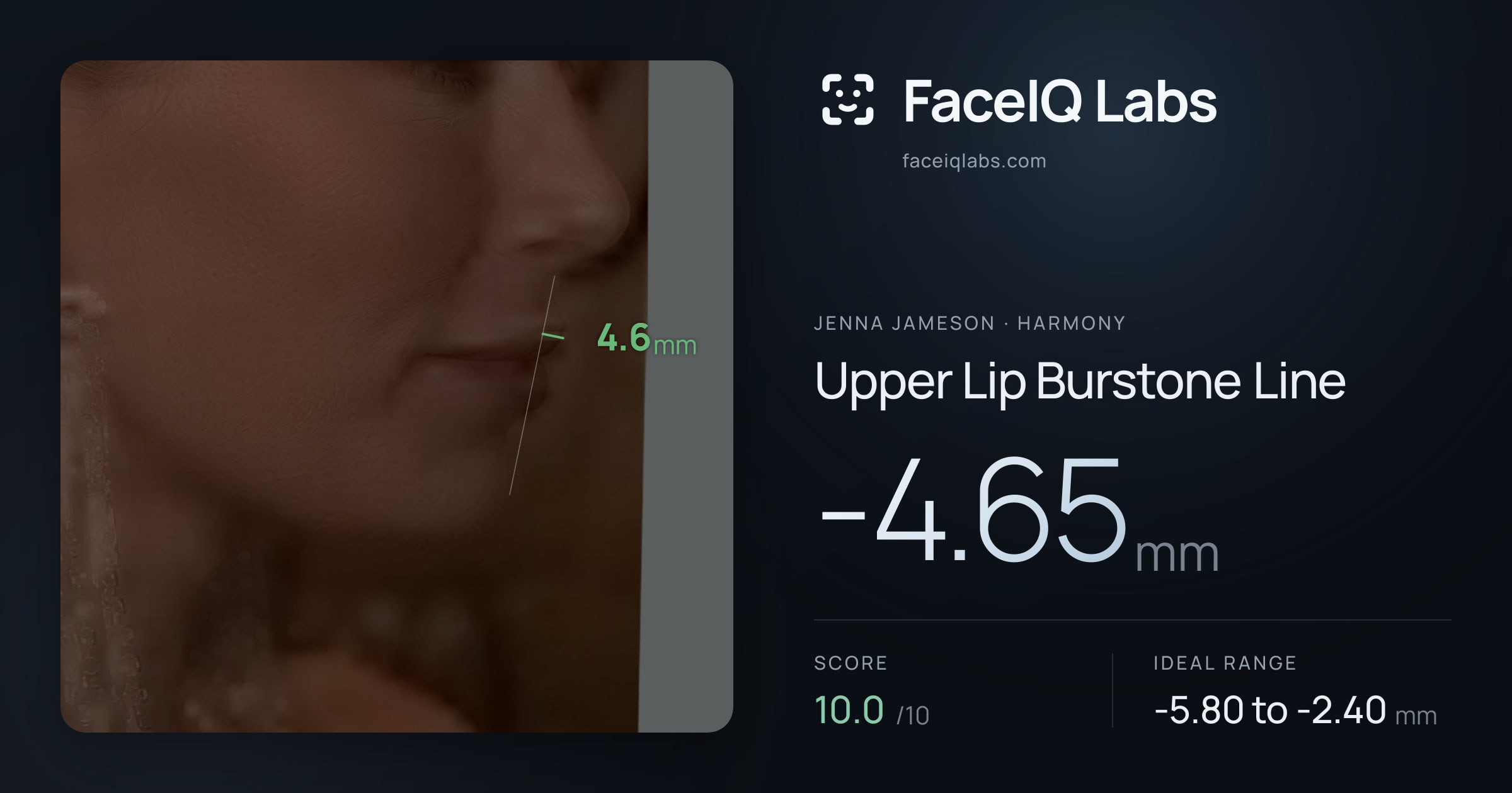 Jenna Jameson Upper Lip Burstone Line: -4.65mm, drawn on the photo