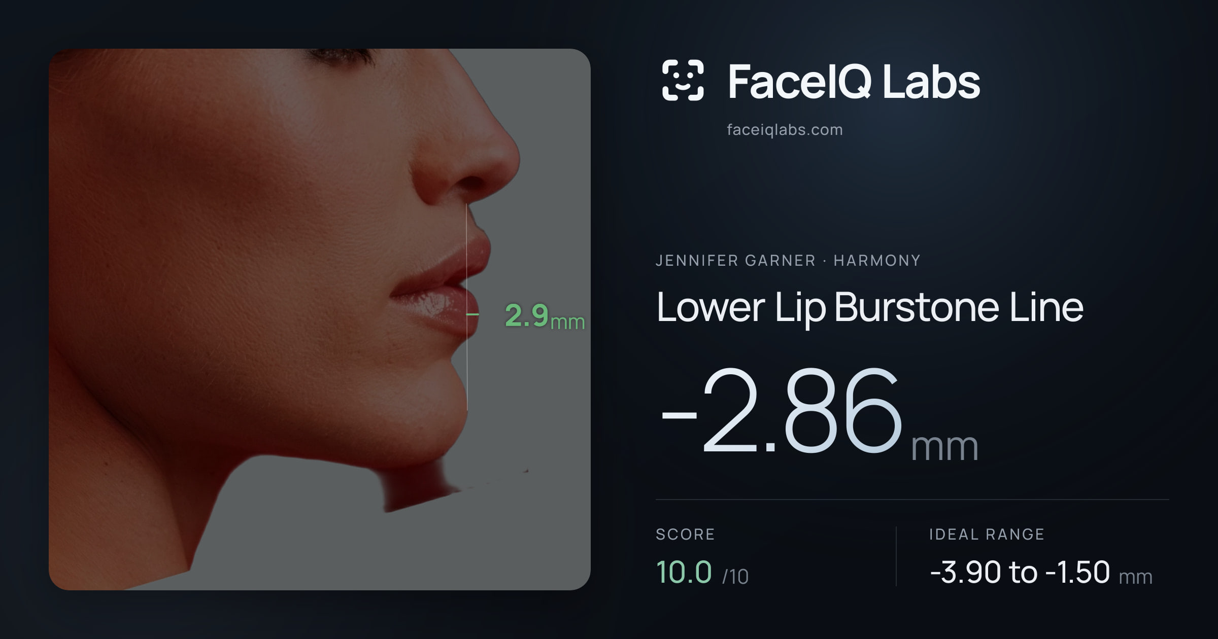 Jennifer Garner Lower Lip Burstone Line: -2.86mm, drawn on the photo