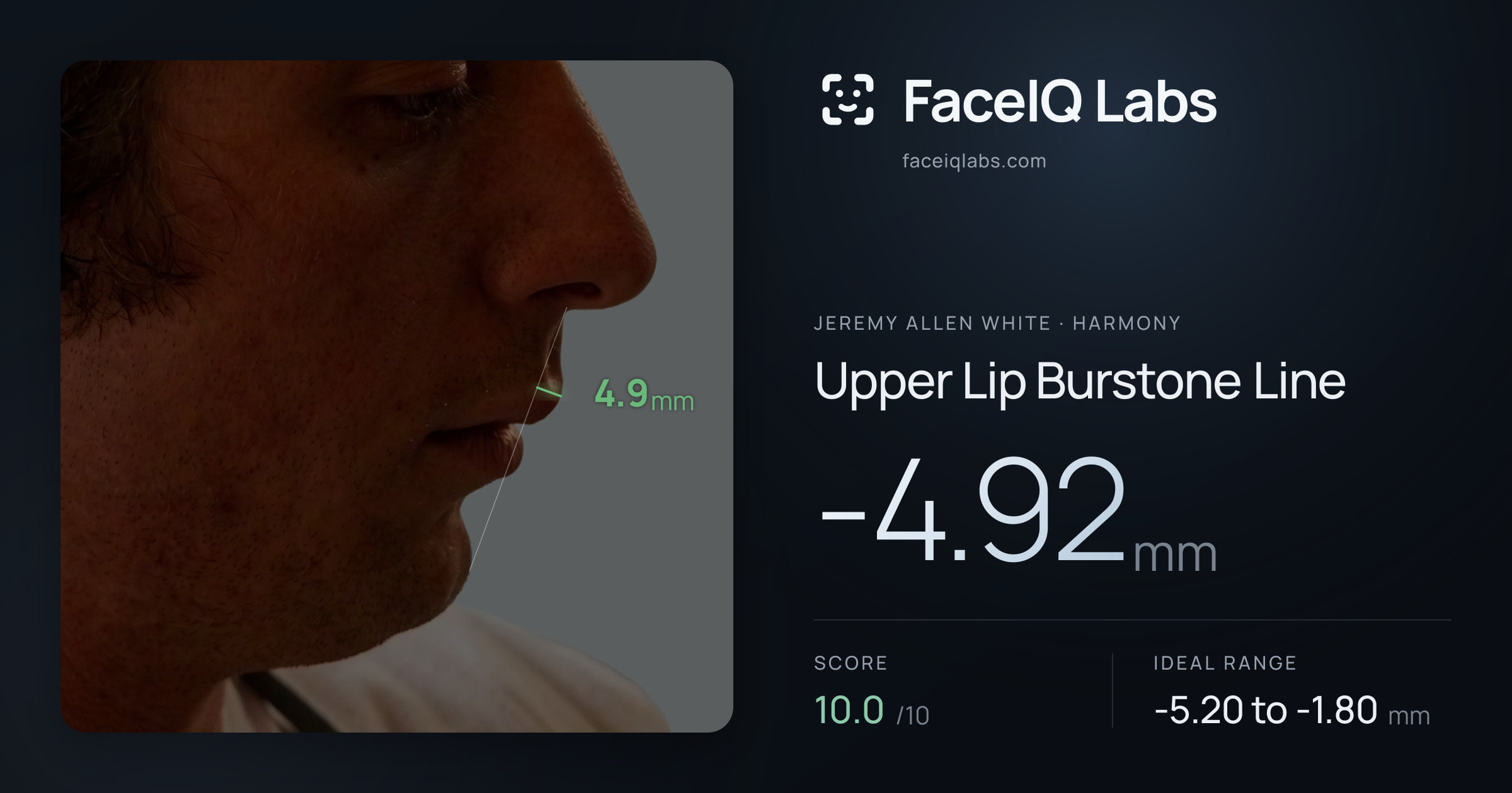 Jeremy Allen White Upper Lip Burstone Line: -4.92mm, drawn on the photo