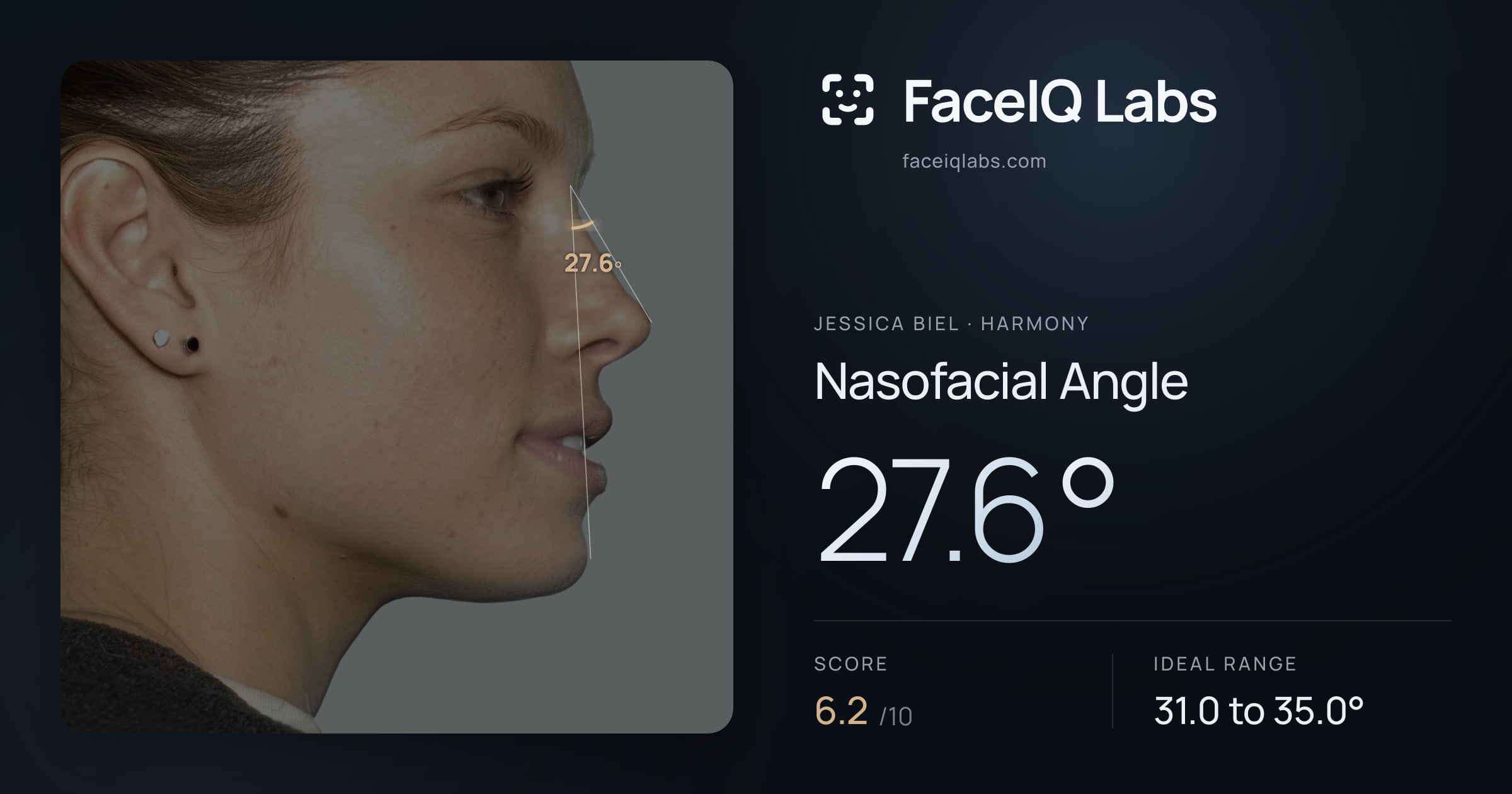 Jessica Biel Nasofacial Angle: 27.6°, drawn on the photo