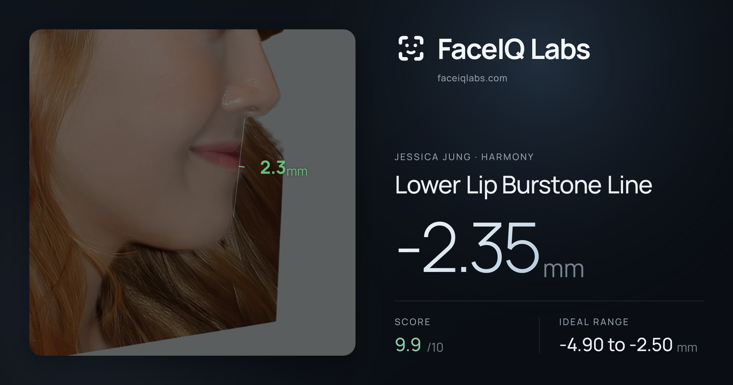 Jessica Jung Lower Lip Burstone Line: -2.35mm, drawn on the photo