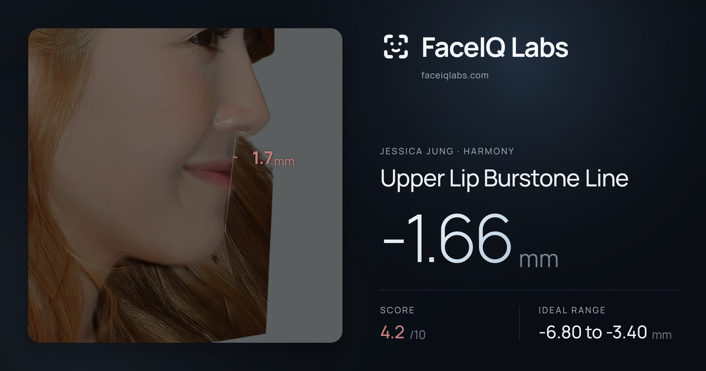 Jessica Jung Upper Lip Burstone Line: -1.66mm, drawn on the photo