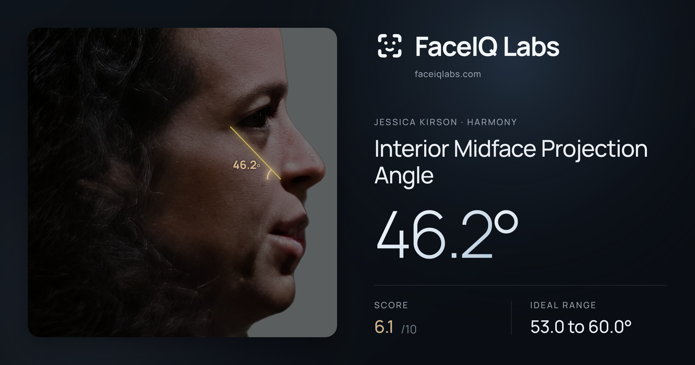 Jessica Kirson Interior Midface Projection Angle: 46.2°, drawn on the photo