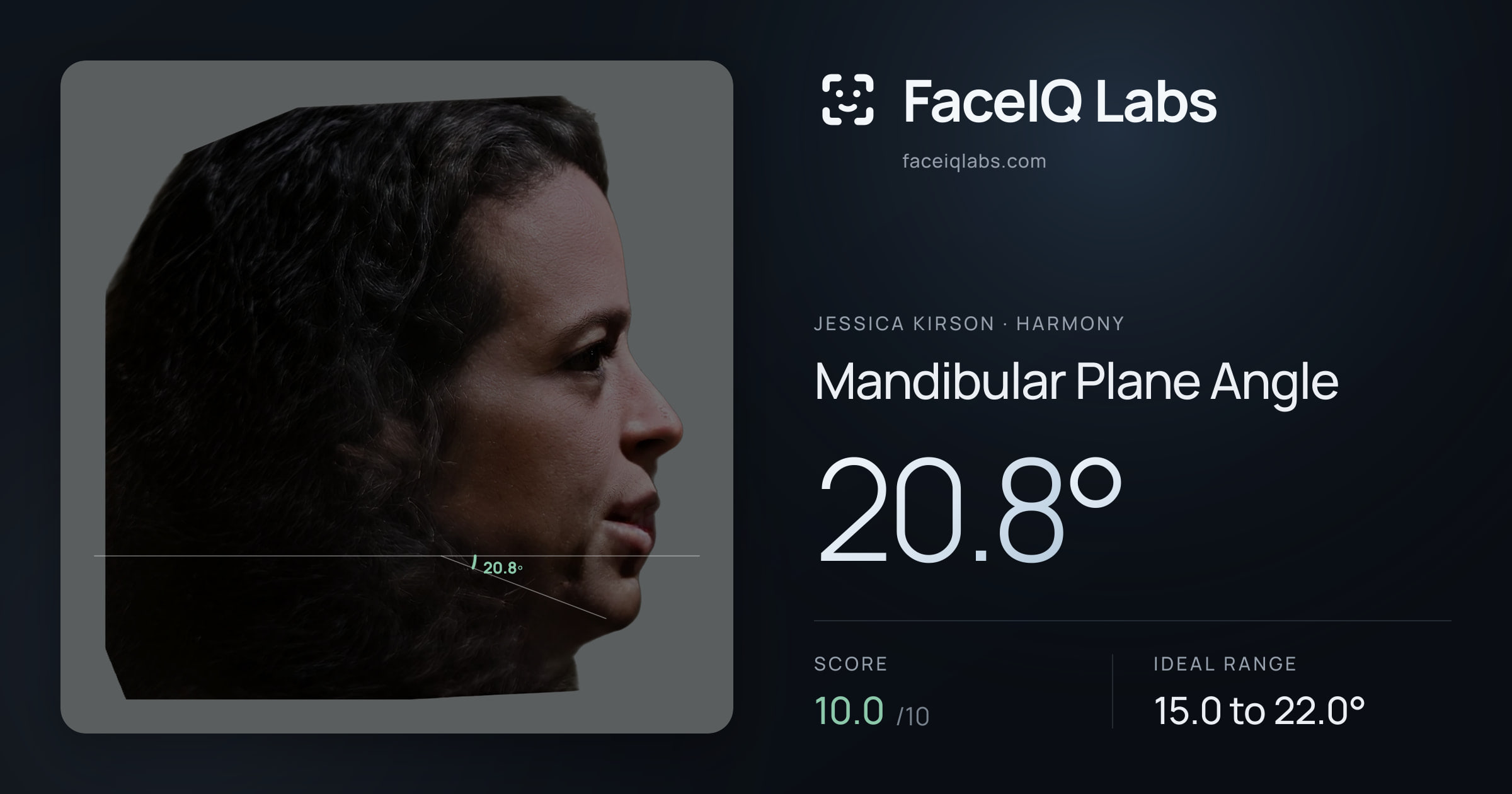 Jessica Kirson Mandibular Plane Angle: 20.8°, drawn on the photo