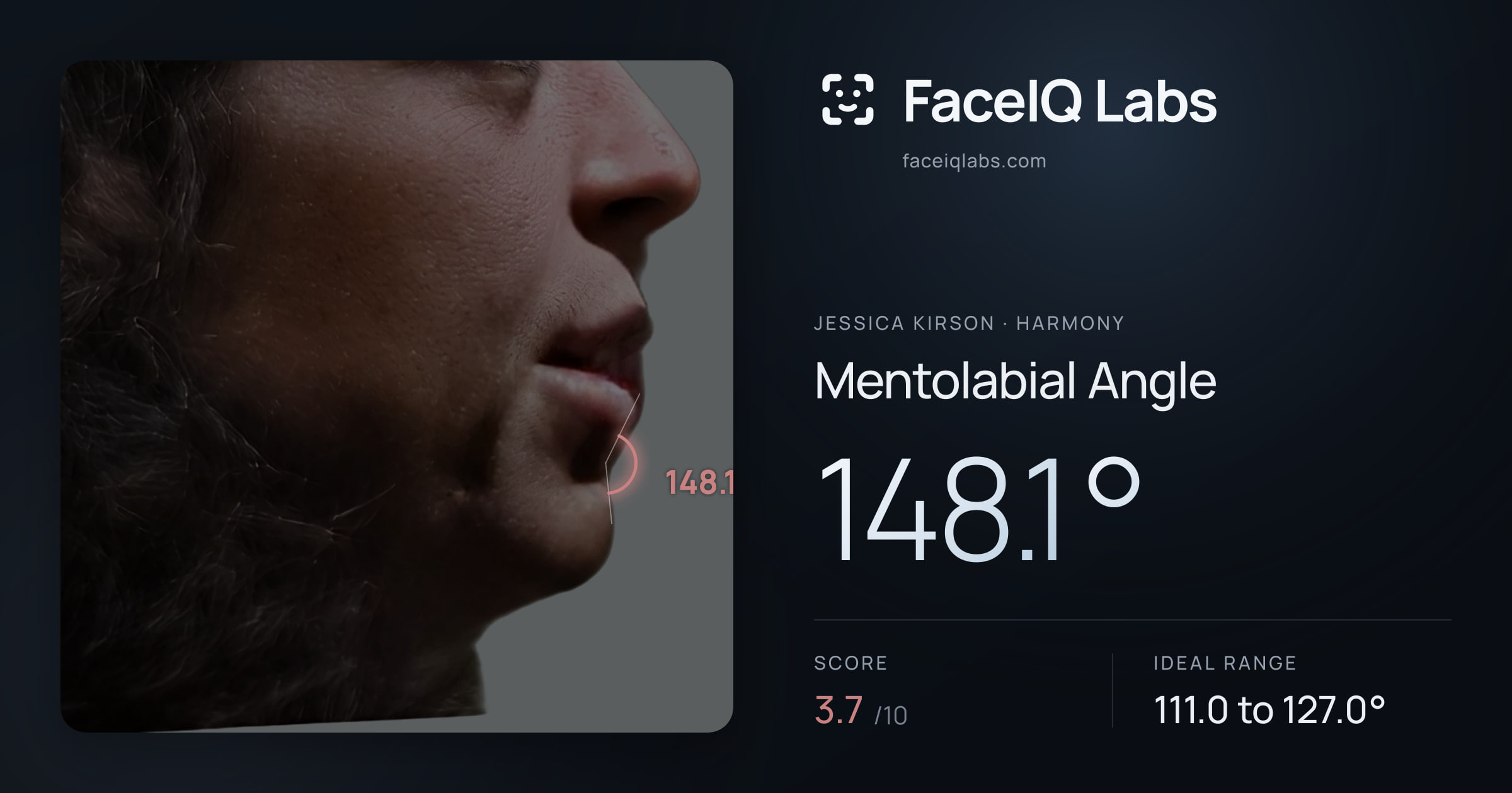 Jessica Kirson Mentolabial Angle: 148.1°, drawn on the photo