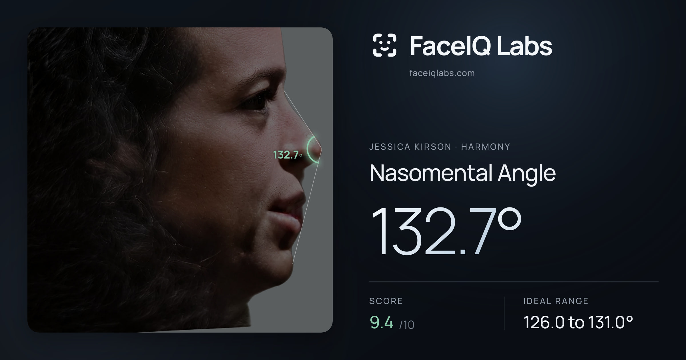 Jessica Kirson Nasomental Angle: 132.7°, drawn on the photo