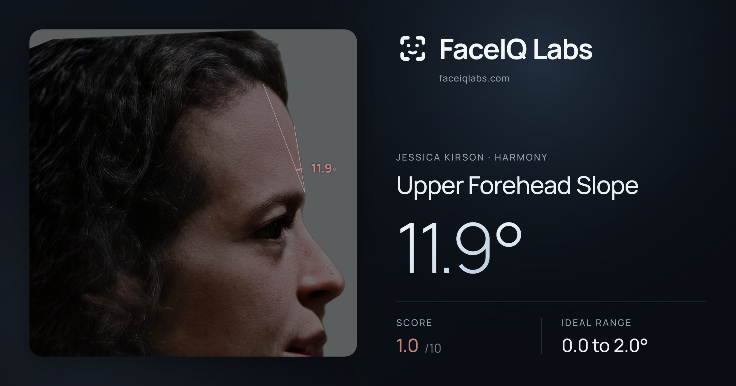 Jessica Kirson Upper Forehead Slope: 11.9°, drawn on the photo
