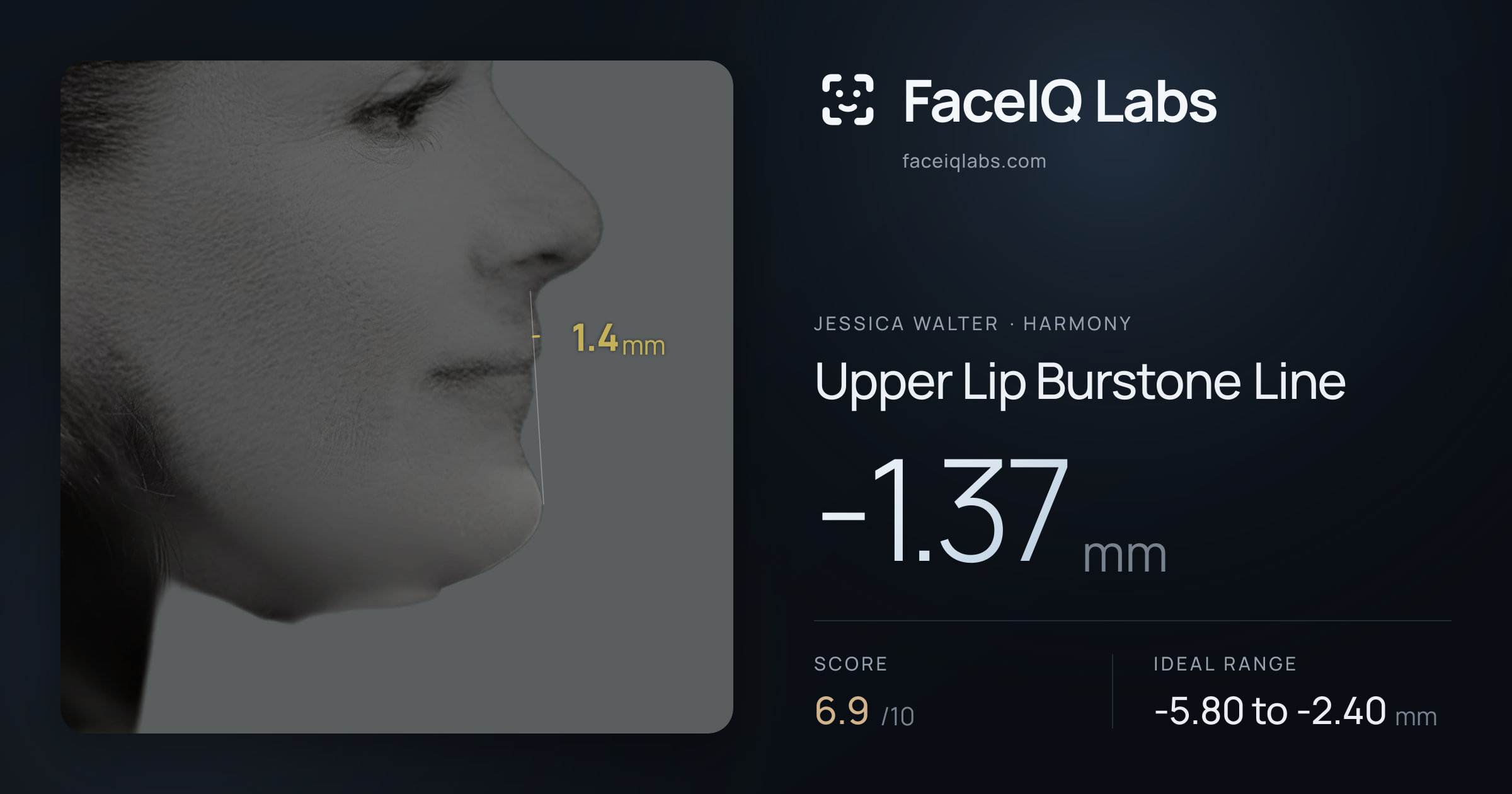 Jessica Walter Upper Lip Burstone Line: -1.37mm, drawn on the photo