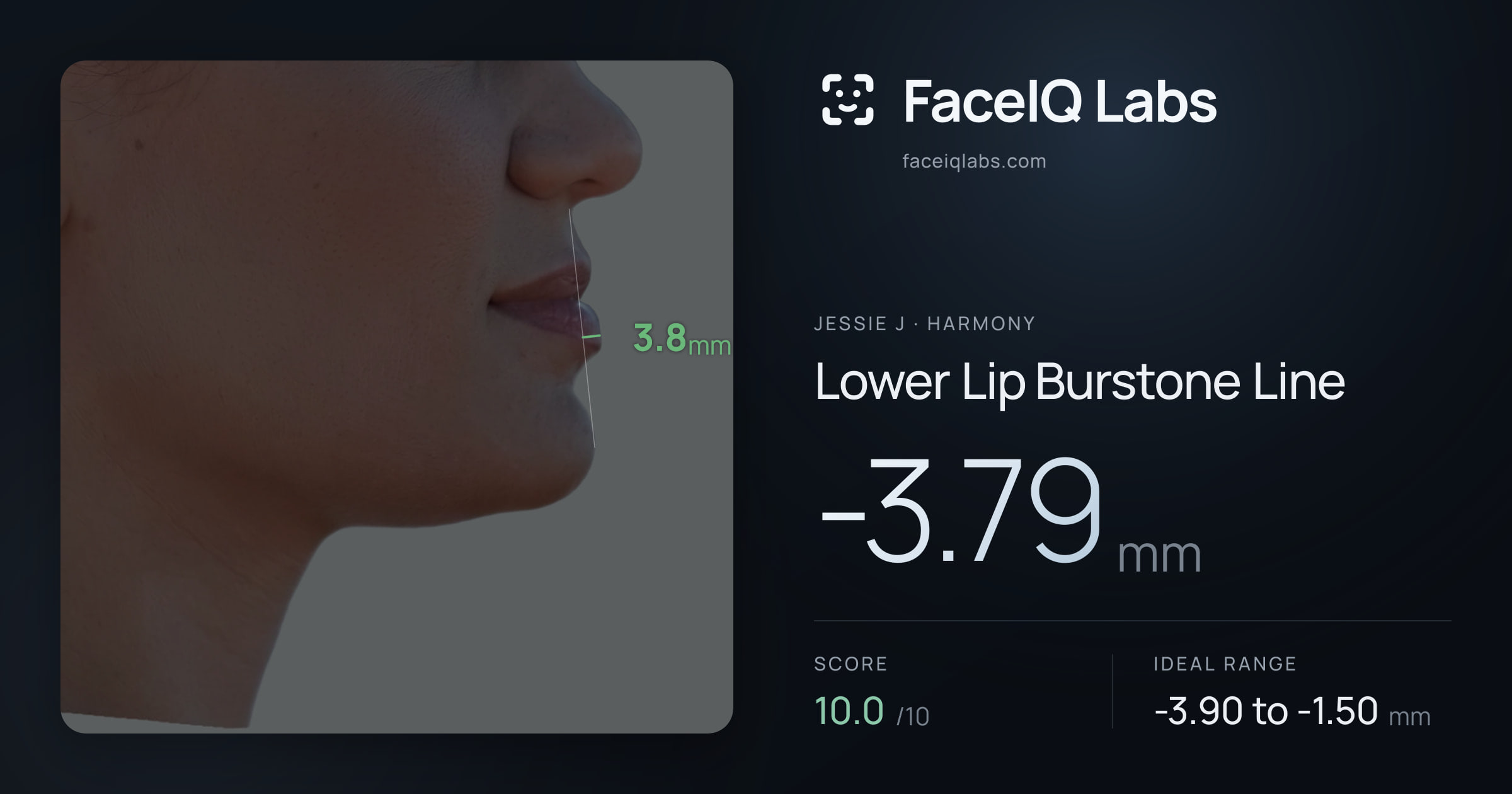 Jessie J Lower Lip Burstone Line: -3.79mm, drawn on the photo