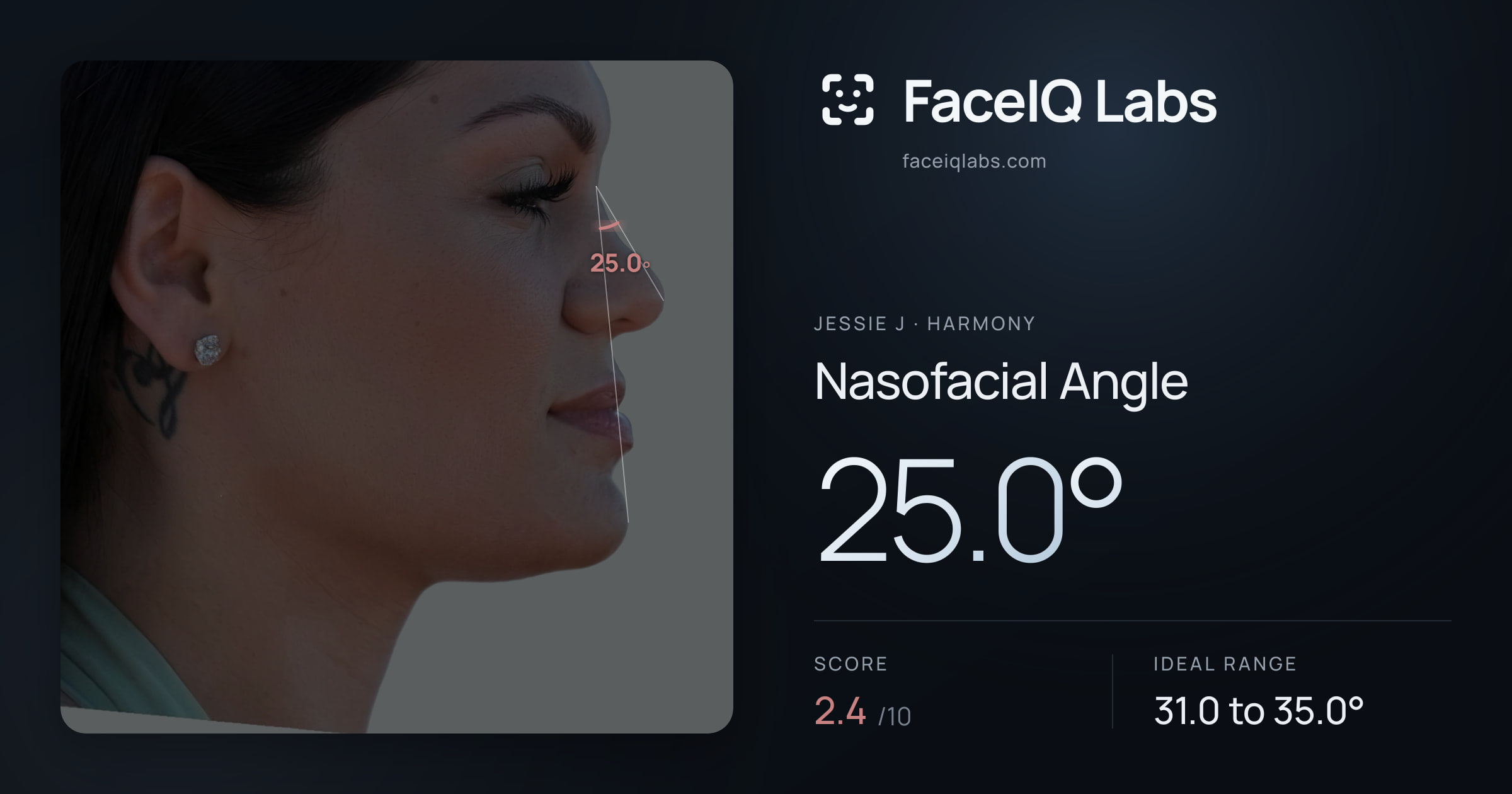 Jessie J Nasofacial Angle: 25.0°, drawn on the photo
