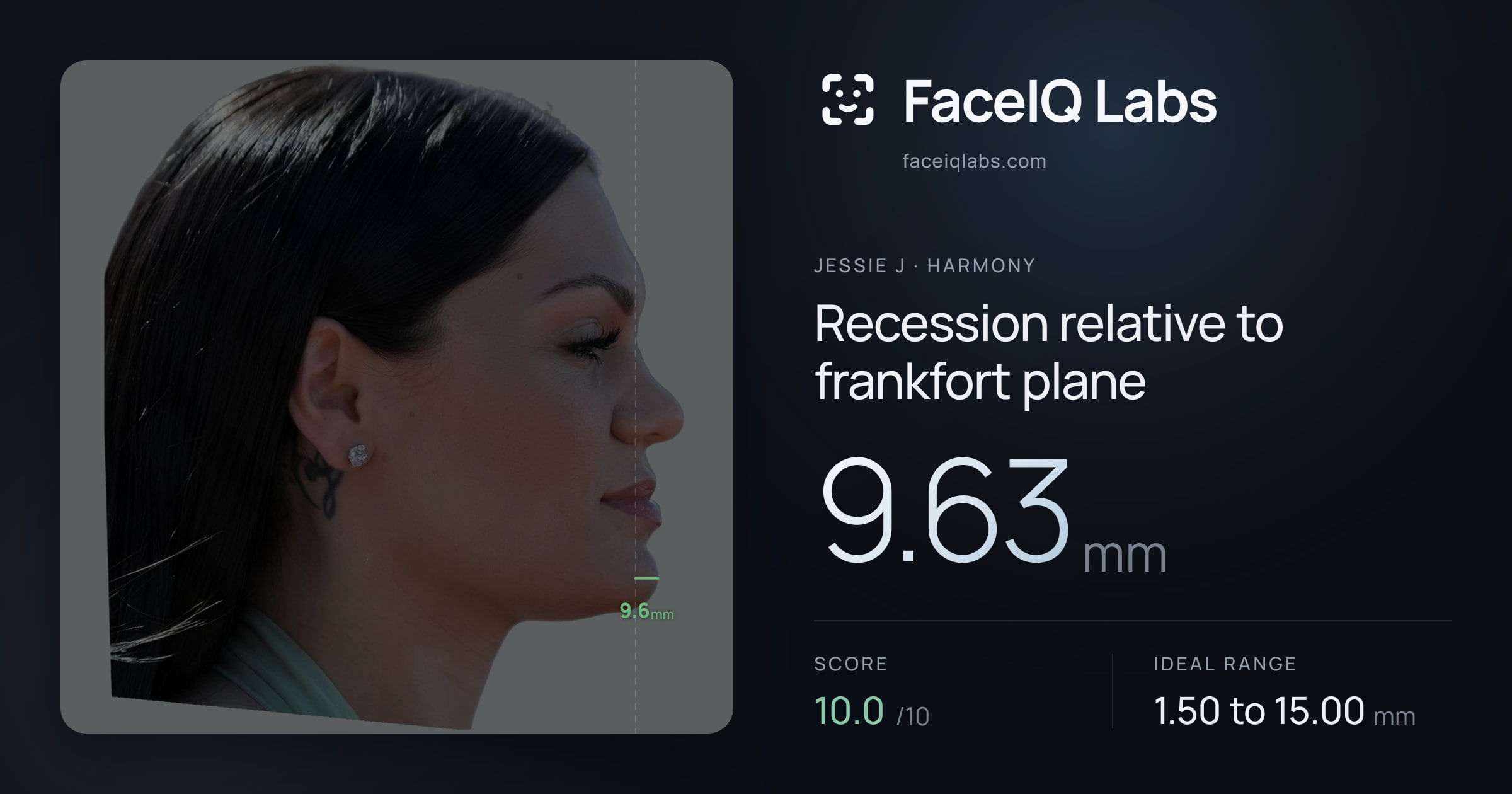 Jessie J Recession relative to frankfort plane: 9.63mm, drawn on the photo