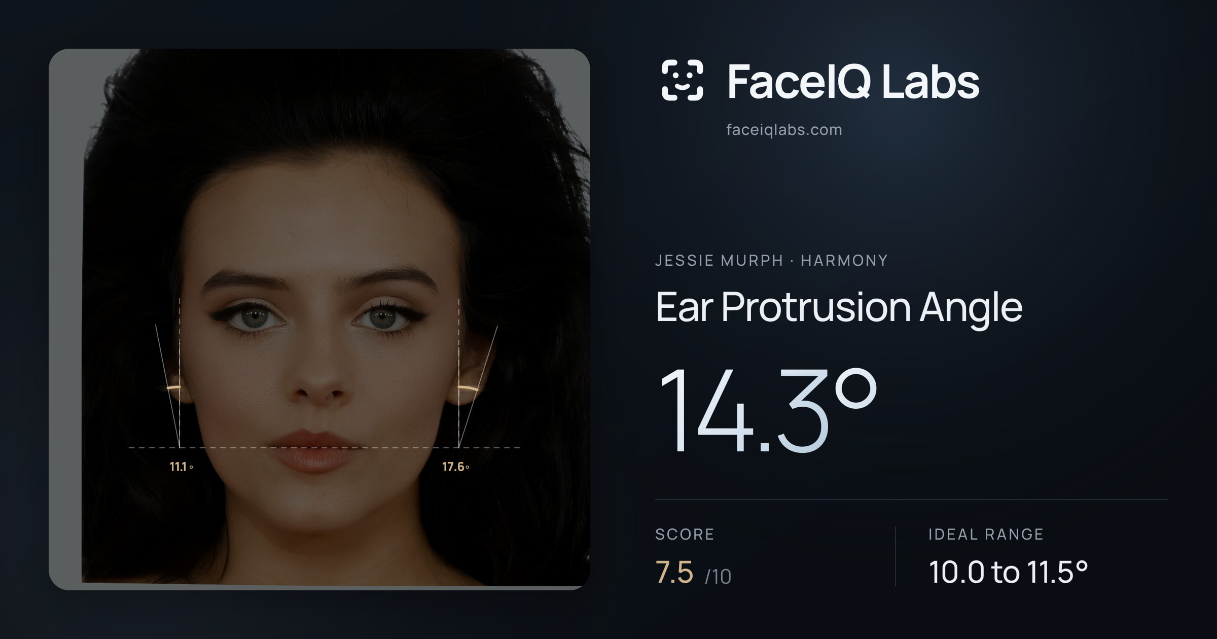 Jessie Murph Ear Protrusion Angle: 14.3°, drawn on the photo