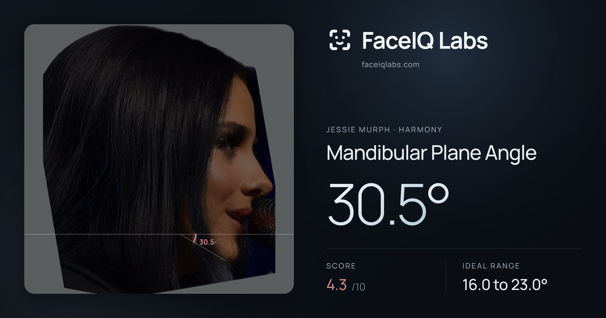 Jessie Murph Mandibular Plane Angle: 30.5°, drawn on the photo