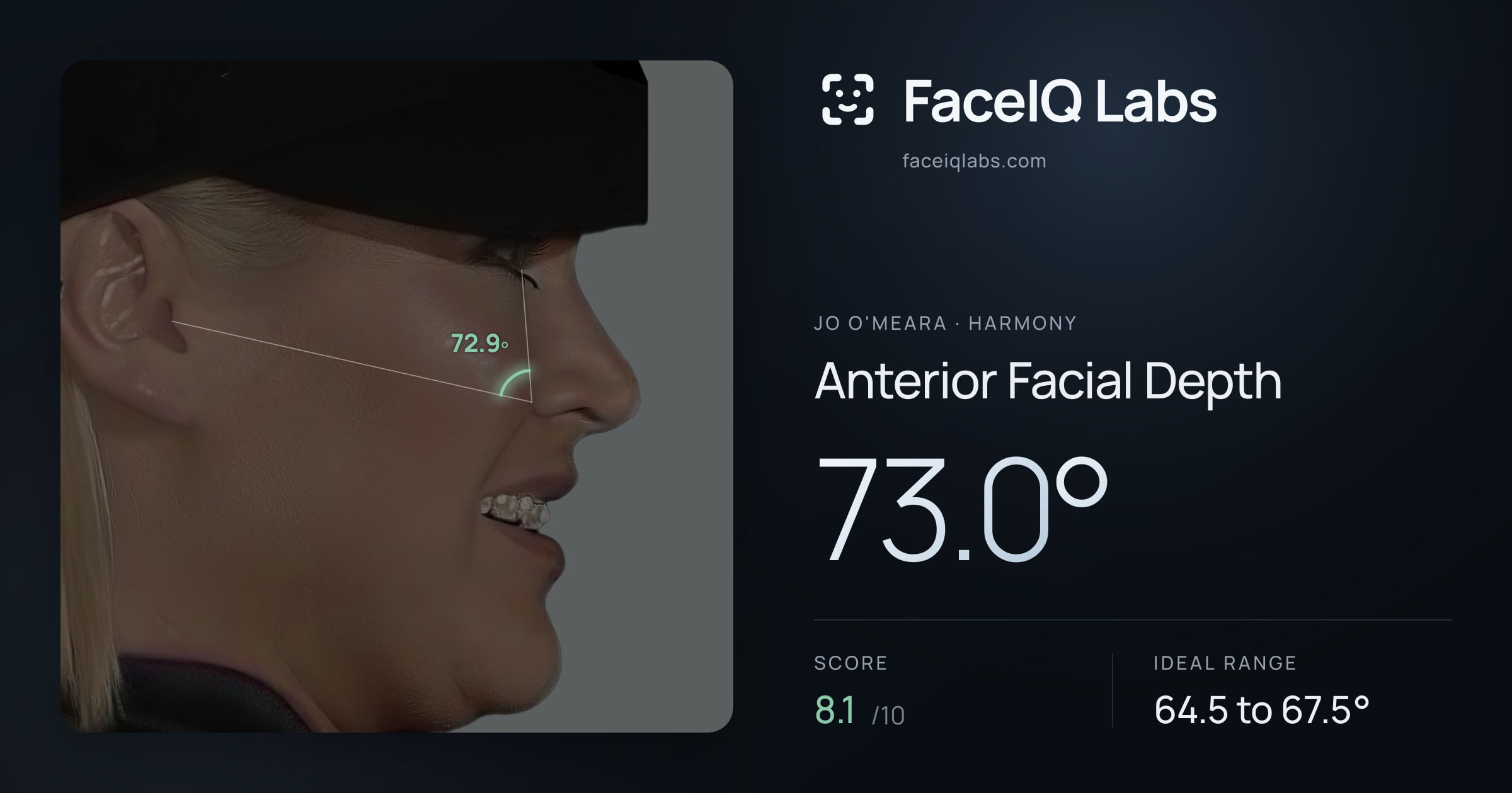 Jo O'Meara Anterior Facial Depth: 73.0°, drawn on the photo