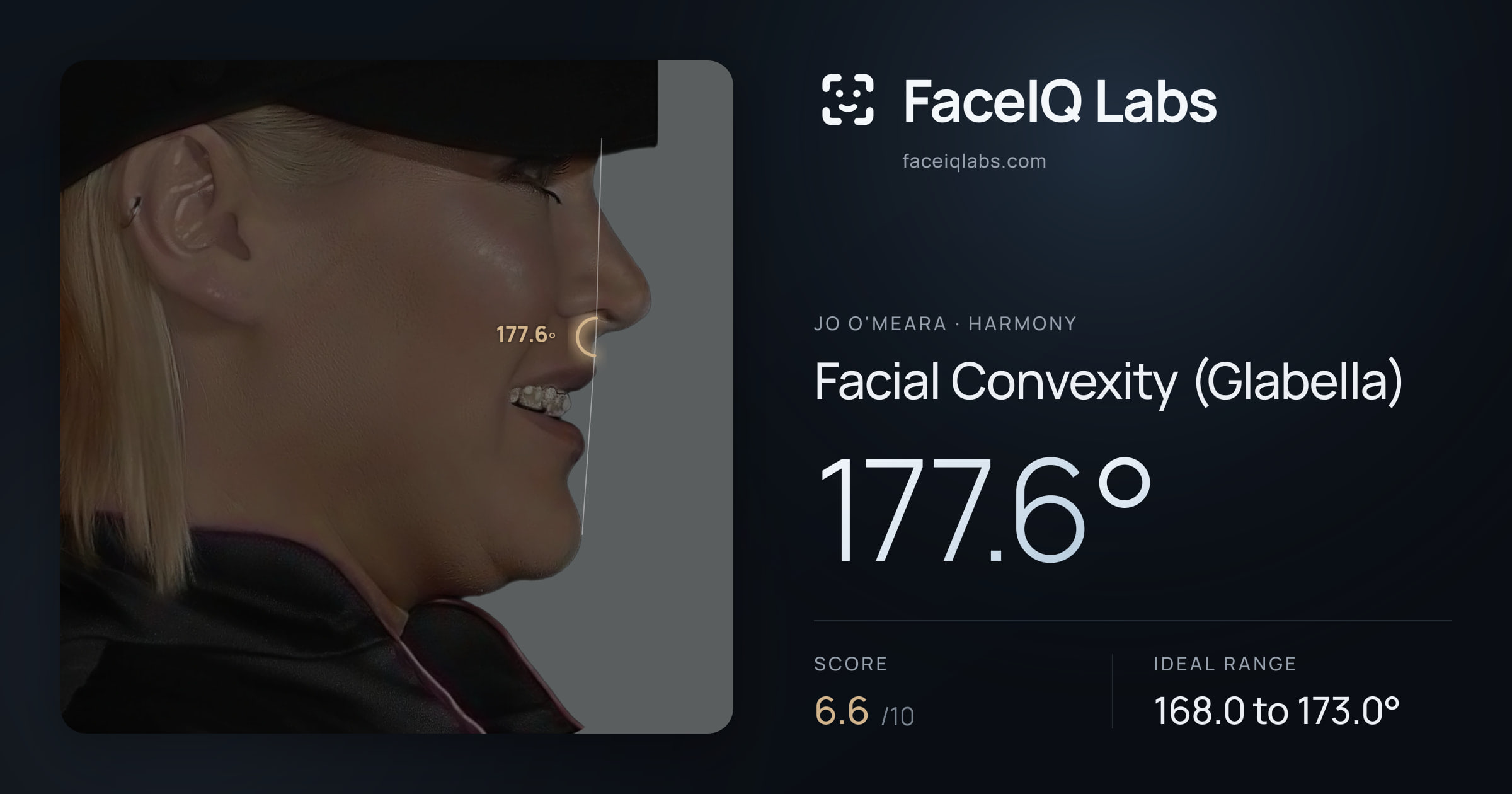 Jo O'Meara Facial Convexity (Glabella): 177.6°, drawn on the photo
