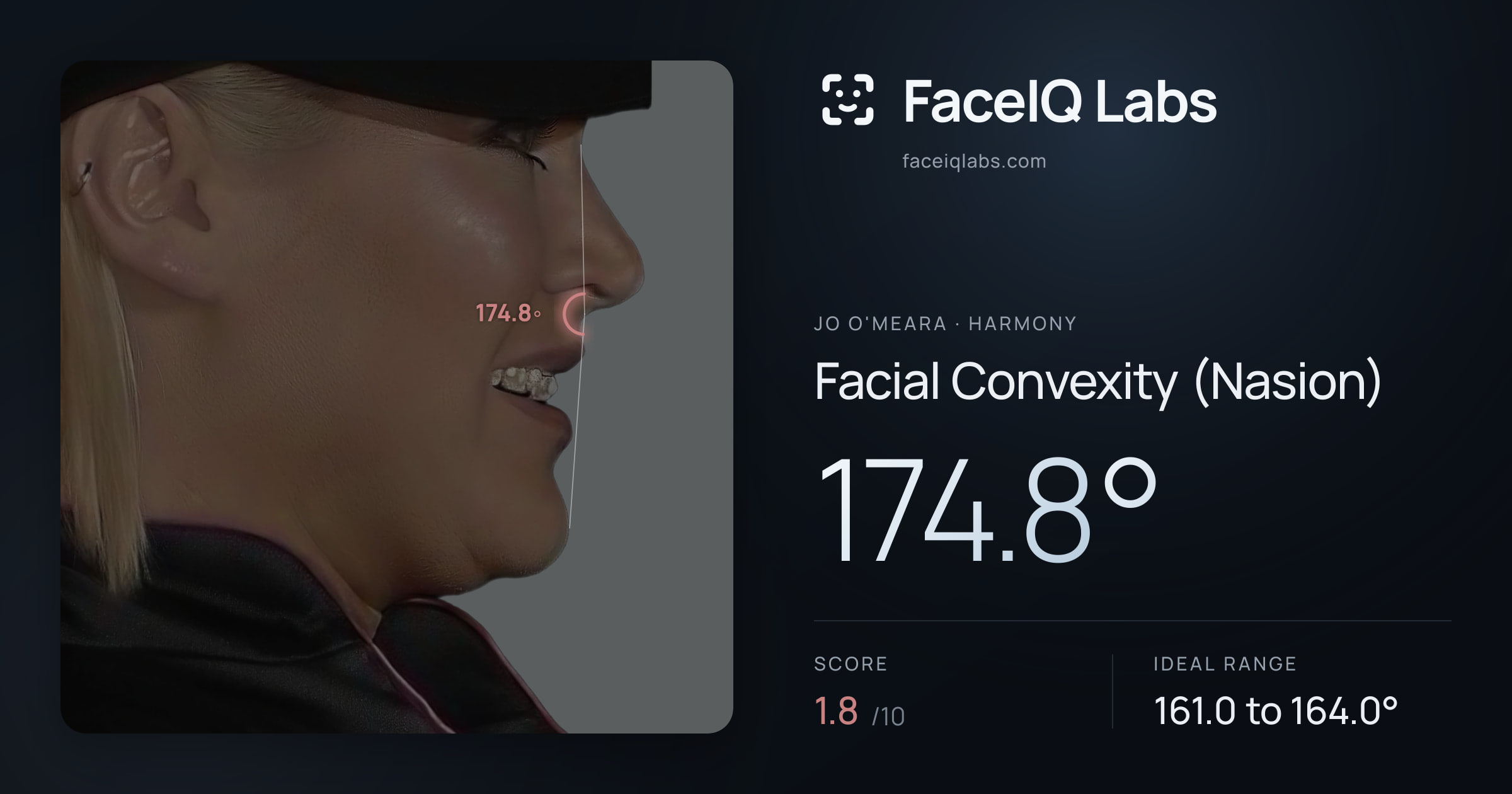 Jo O'Meara Facial Convexity (Nasion): 174.8°, drawn on the photo