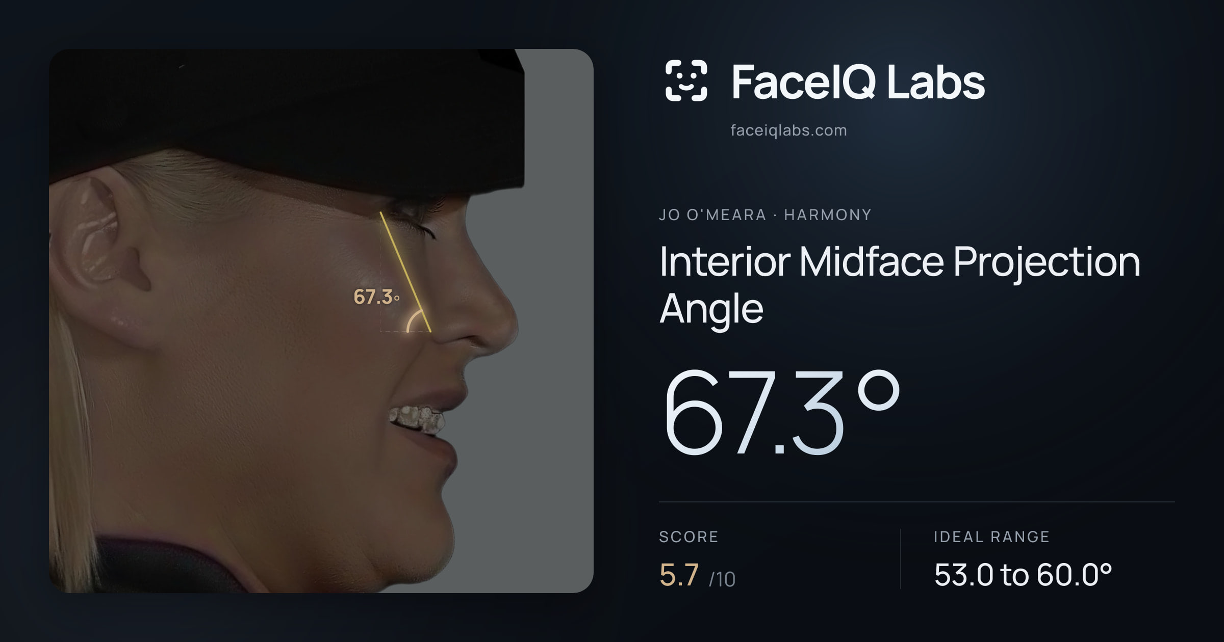 Jo O'Meara Interior Midface Projection Angle: 67.3°, drawn on the photo