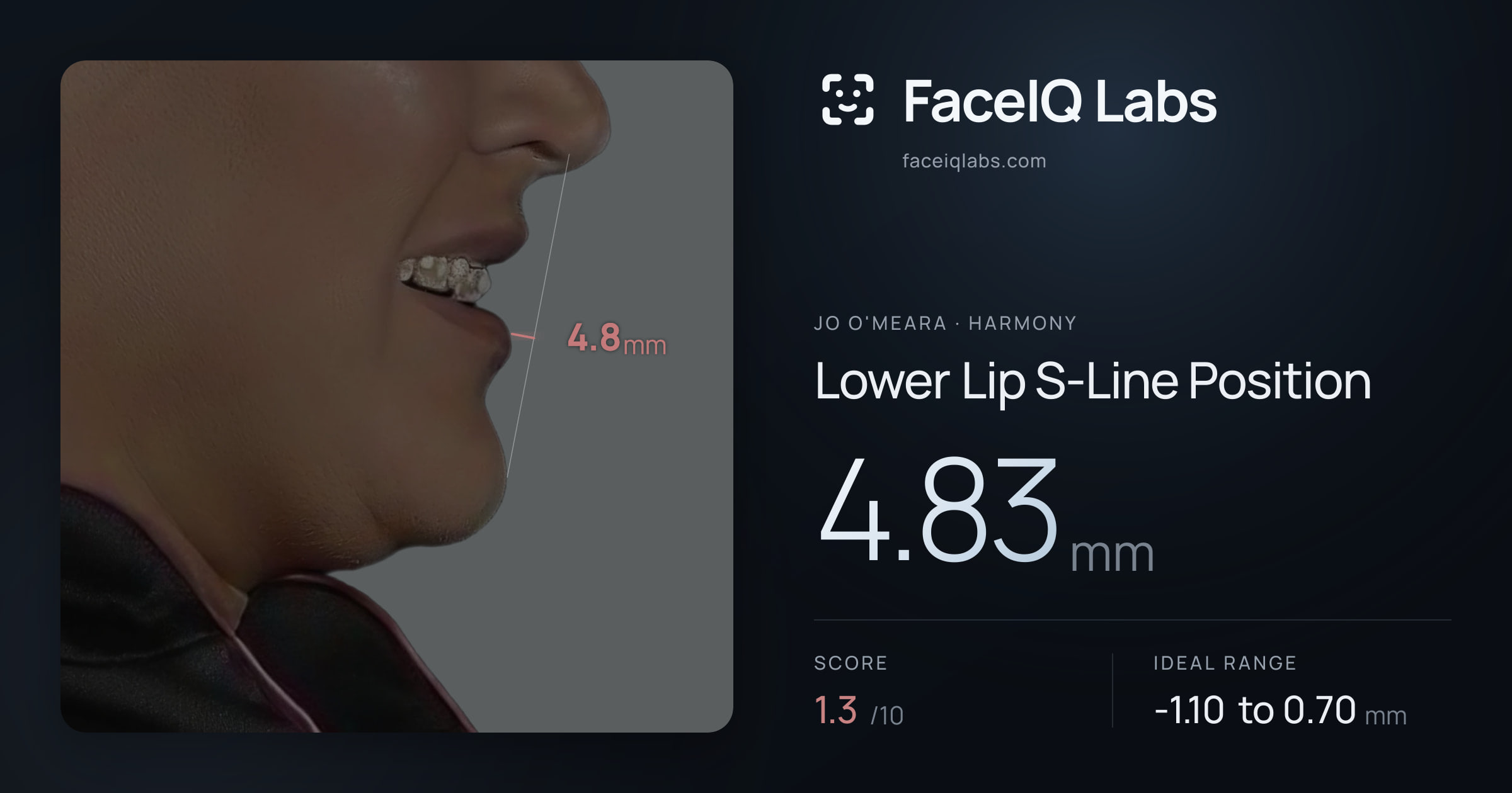 Jo O'Meara Lower Lip S-Line Position: 4.83mm, drawn on the photo