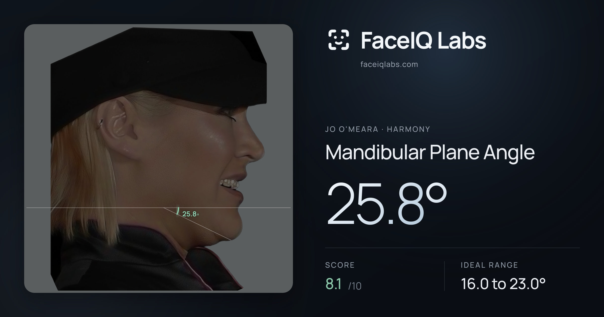 Jo O'Meara Mandibular Plane Angle: 25.8°, drawn on the photo