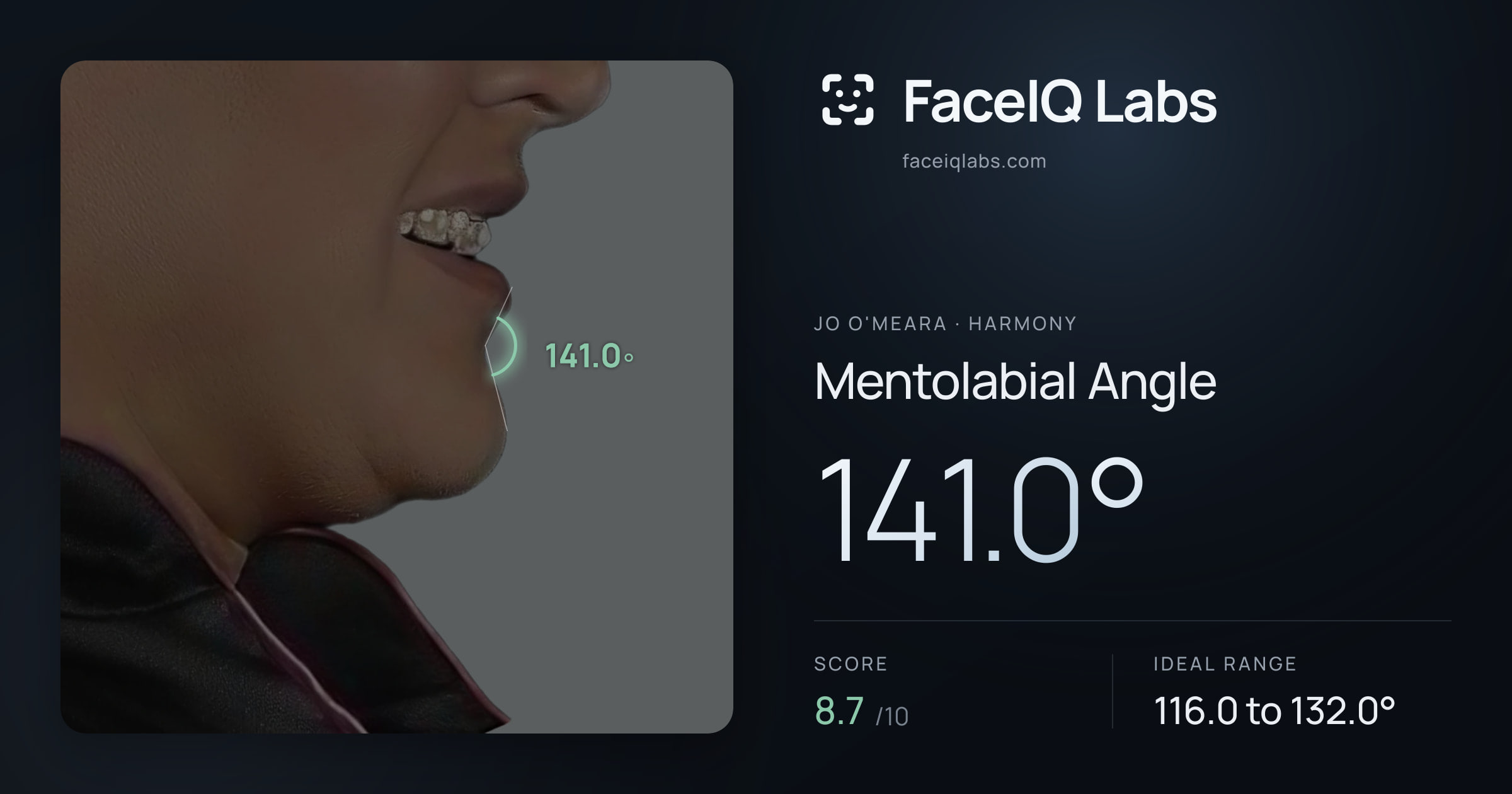 Jo O'Meara Mentolabial Angle: 141.0°, drawn on the photo