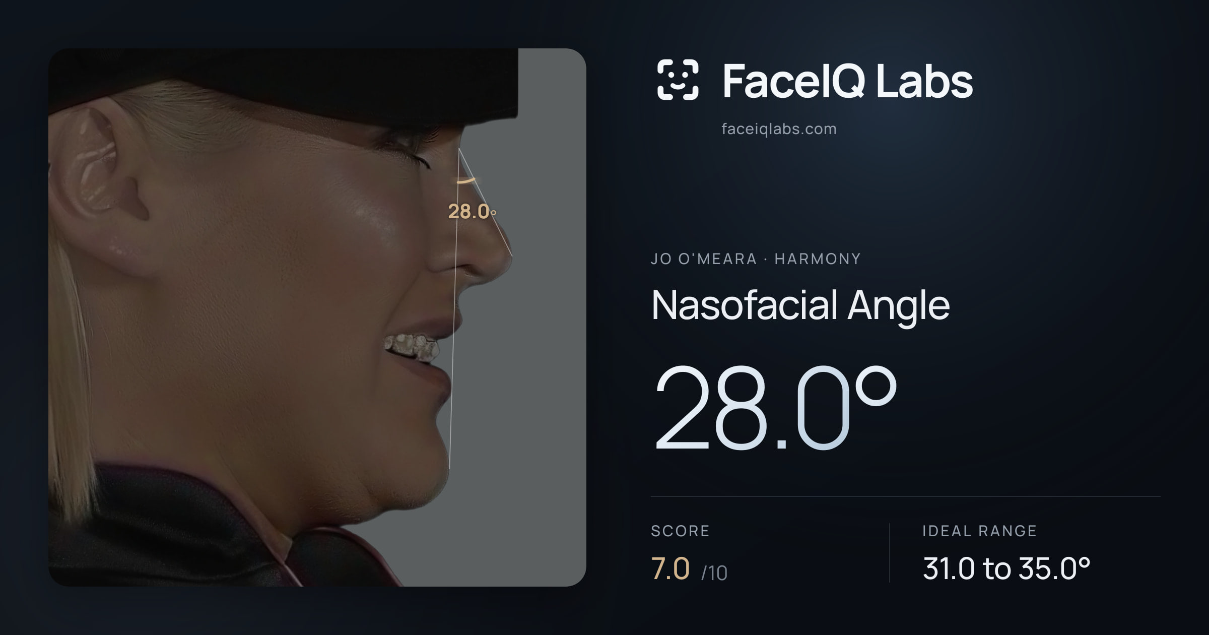 Jo O'Meara Nasofacial Angle: 28.0°, drawn on the photo
