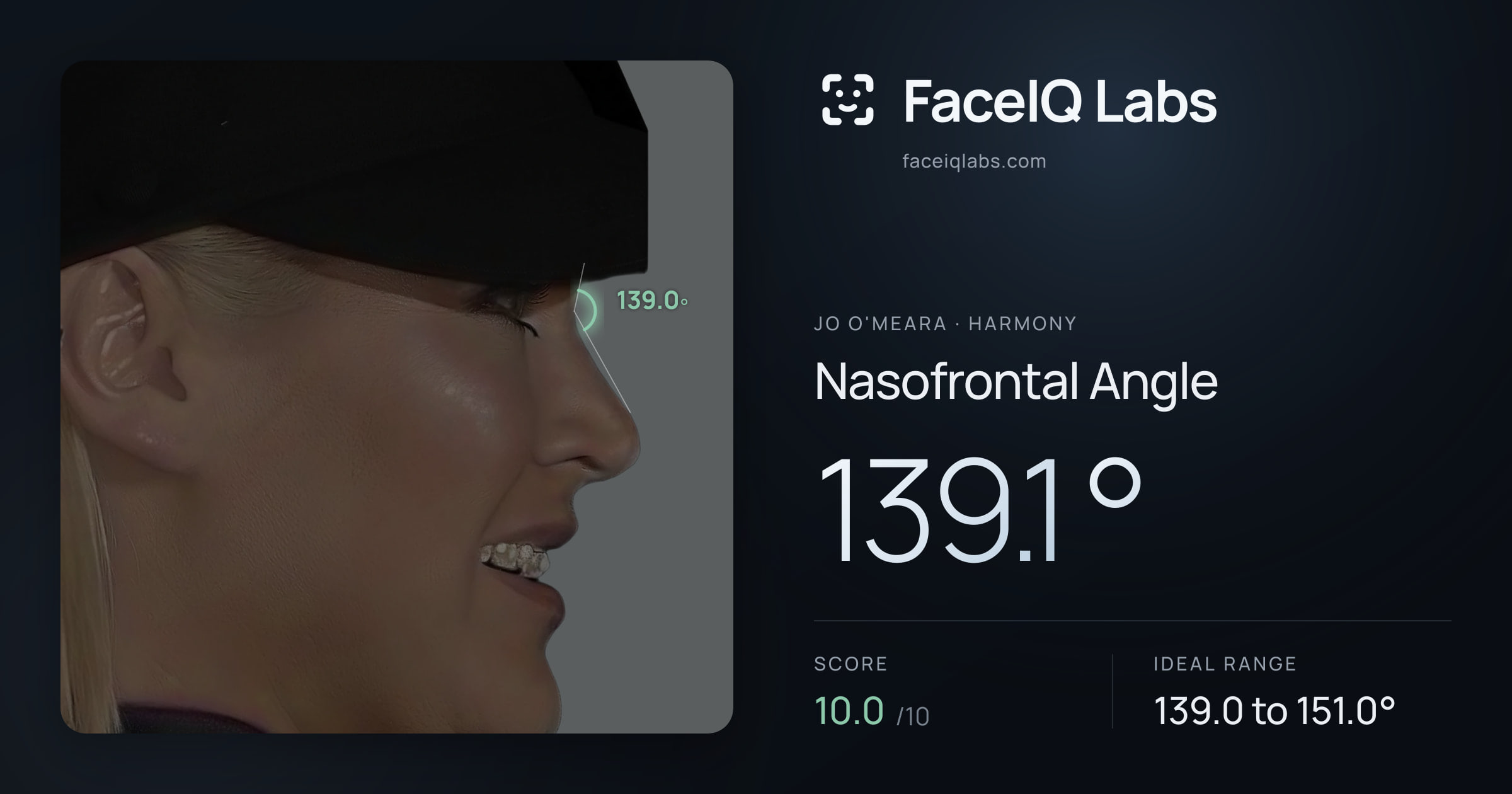 Jo O'Meara Nasofrontal Angle: 139.1°, drawn on the photo