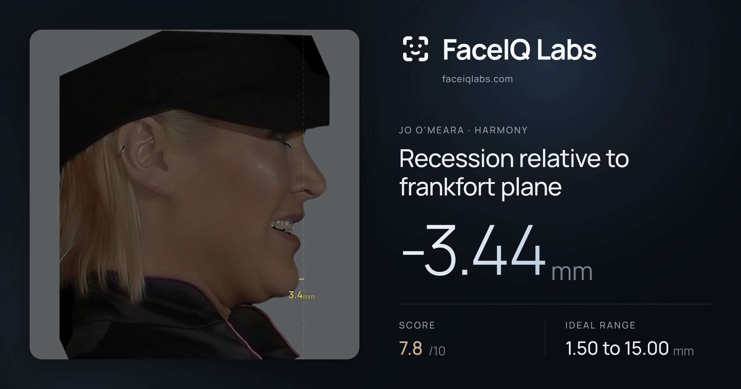 Jo O'Meara Recession relative to frankfort plane: -3.44mm, drawn on the photo