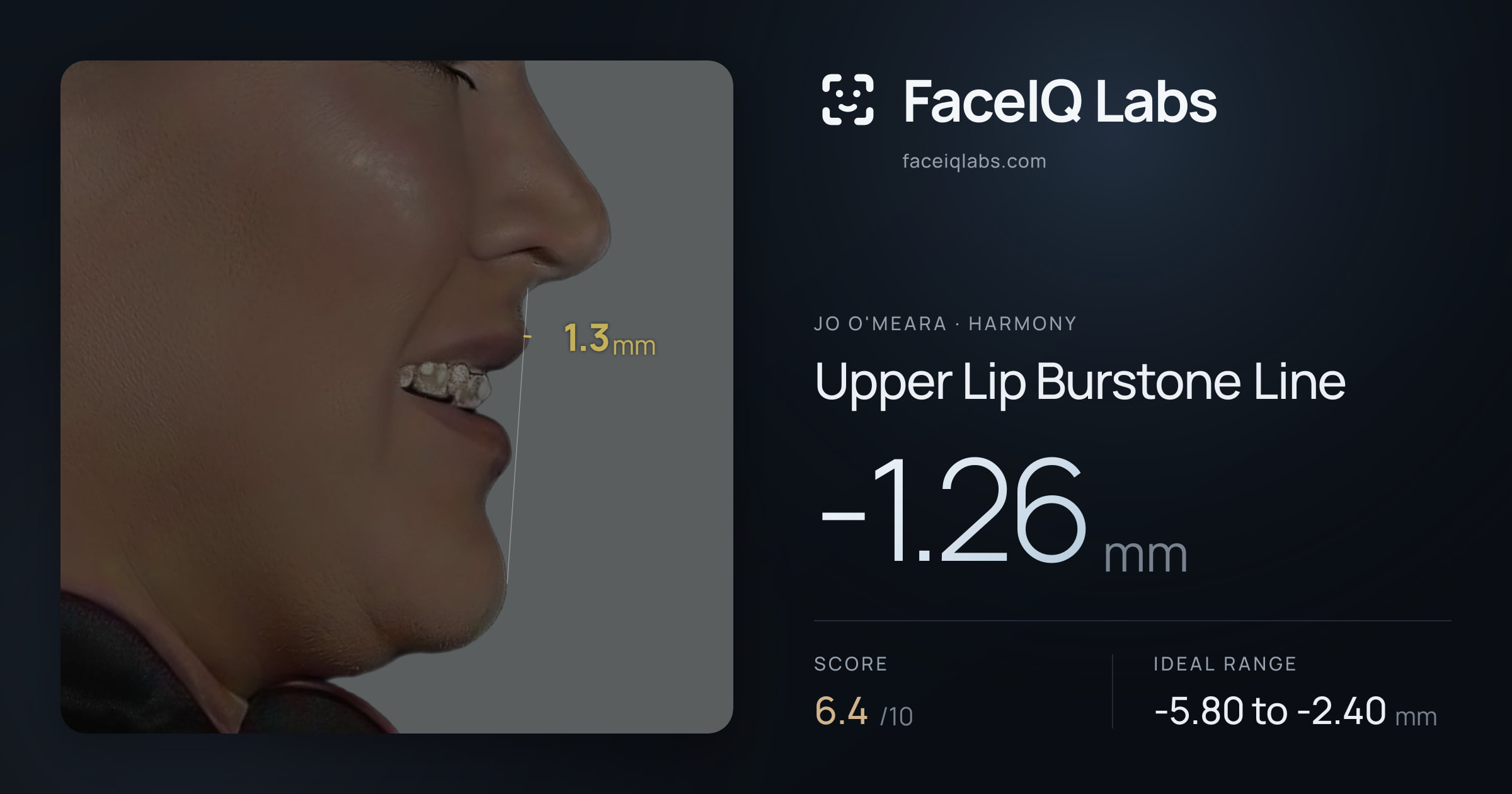 Jo O'Meara Upper Lip Burstone Line: -1.26mm, drawn on the photo