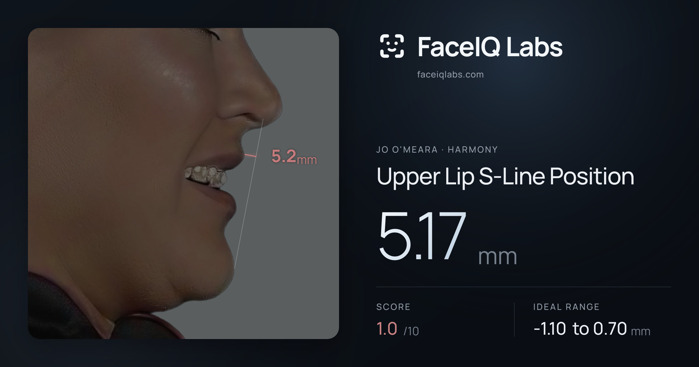 Jo O'Meara Upper Lip S-Line Position: 5.17mm, drawn on the photo