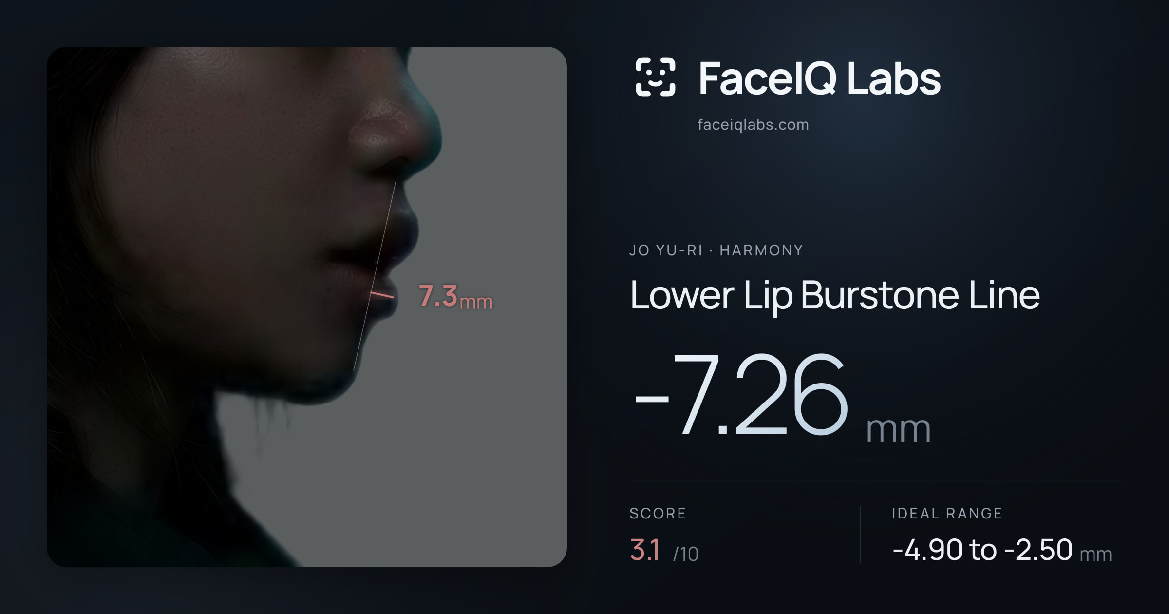 Jo Yu-ri Lower Lip Burstone Line: -7.26mm, drawn on the photo