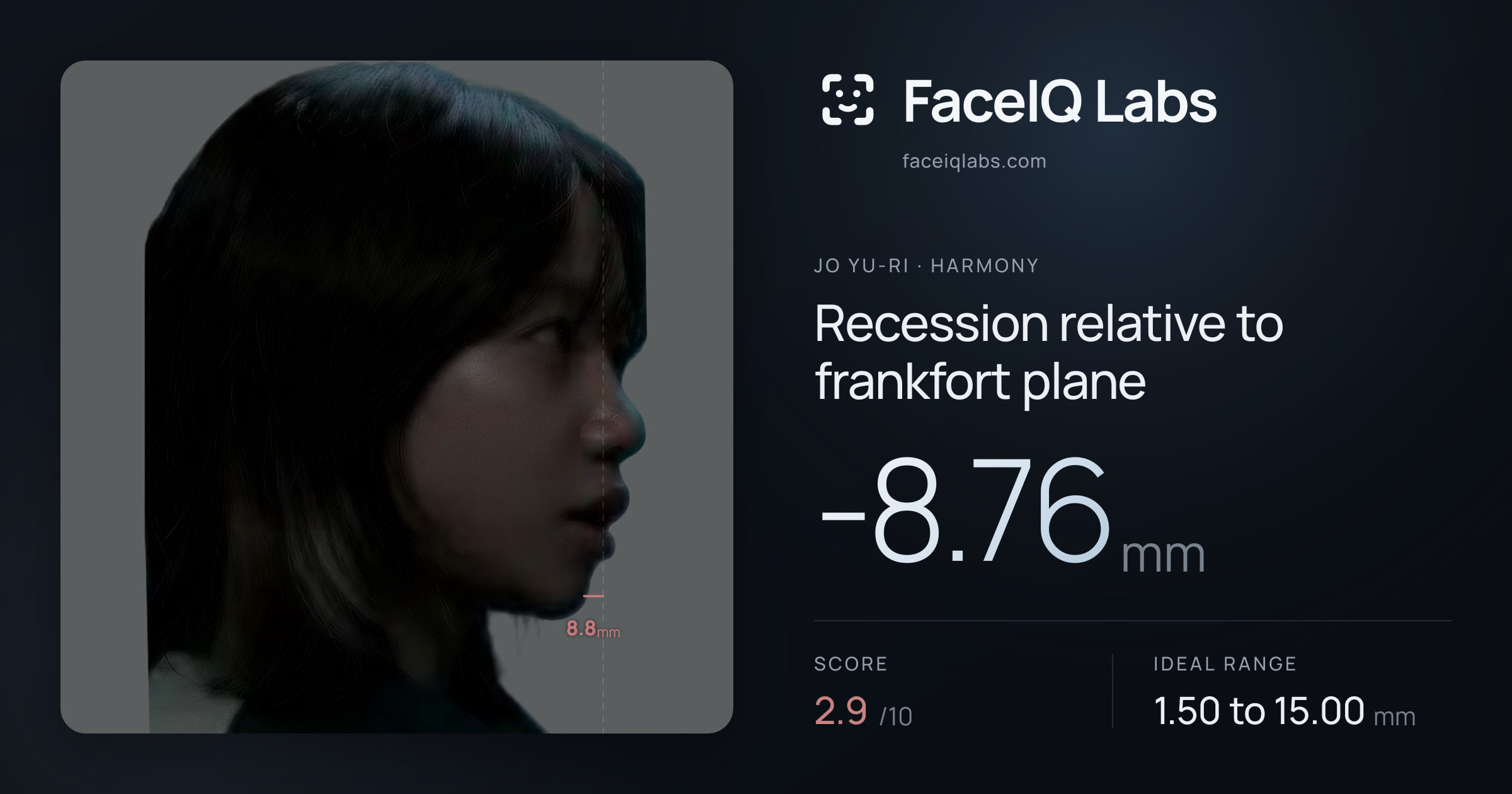 Jo Yu-ri Recession relative to frankfort plane: -8.76mm, drawn on the photo