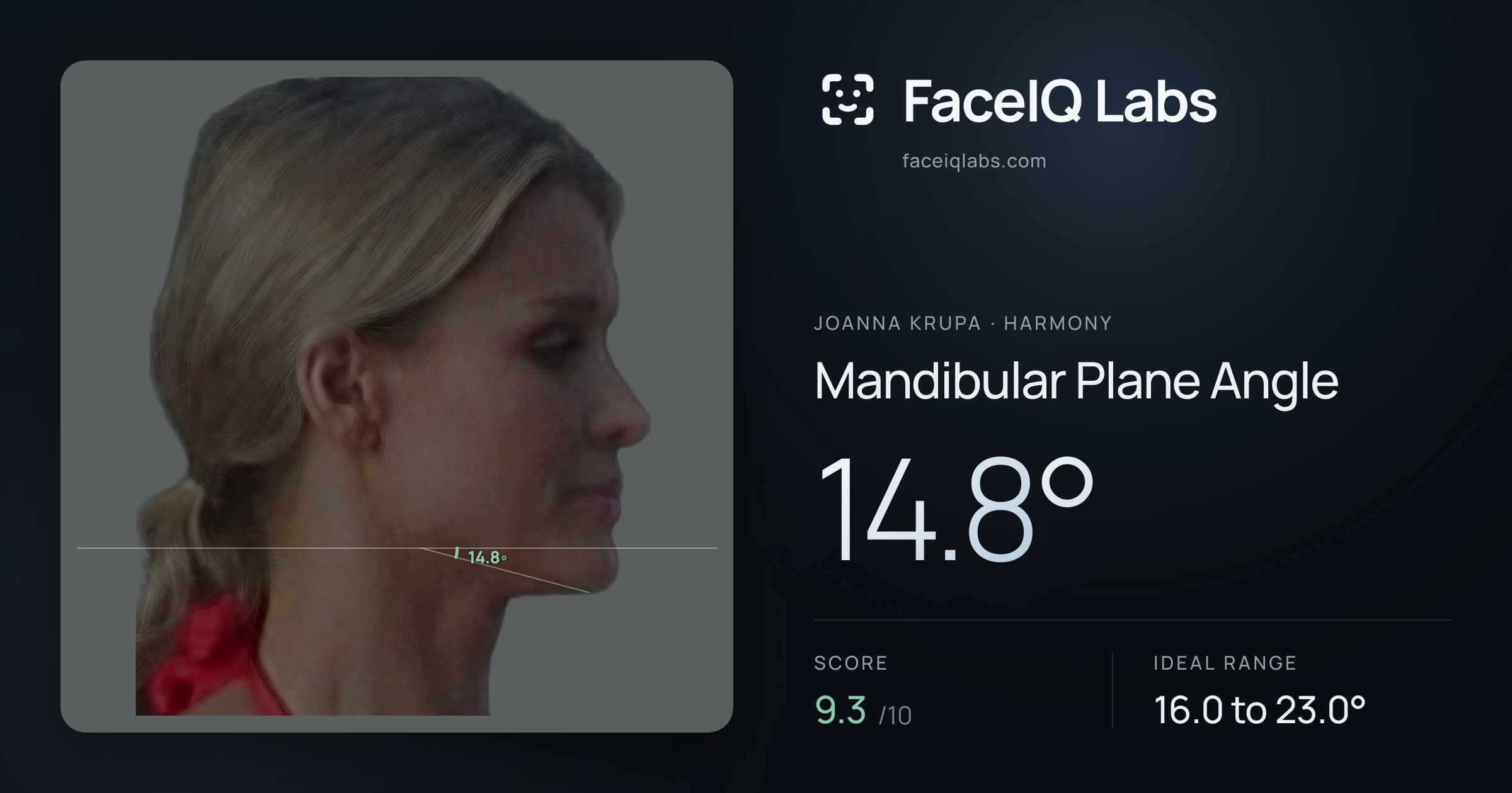 Joanna Krupa Mandibular Plane Angle: 14.8°, drawn on the photo