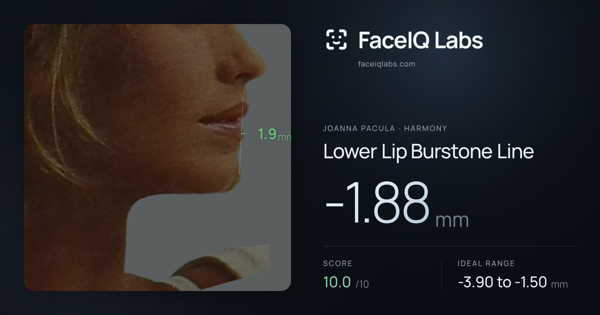Joanna Pacula Lower Lip Burstone Line: -1.88mm, drawn on the photo